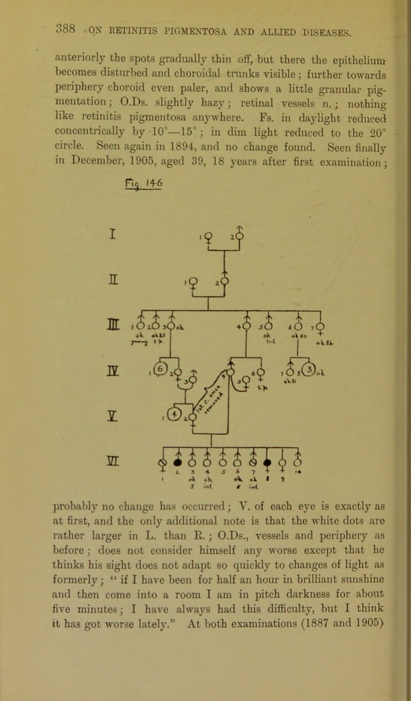 anteriorly the spots gradually thin off, but there the epithelium becomes disturbed and choroidal trunks visible; further towards periphery choroid even paler, and shows a little granular pig- mentation ; O.Ds. slightly hazy; retinal vessels n.; nothing like retinitis pigmentosa anywhere. Fs. in daylight reduced concentrically by 10—15°; in dim light reduced to the 20° circle. Seen again in 1894, and no change found. Seen finally in December, 1905, aged 39, 18 years after first examination; Fi<j. 146 probably no change has occurred; V. of each eye is exactly as at first, and the only additional note is that the white dots are rather larger in L. than E.; O.Ds., vessels and periphery as before; does not consider himself any worse except that he thinks his sight does not adapt so quickly to changes of light as formerly; “ if I have been for half an hour in brilliant sunshine and then come into a room I am in pitch darkness for about five minutes; I have always had this difficulty, but I think it has got worse lately.” At both examinations (1887 and 1905)