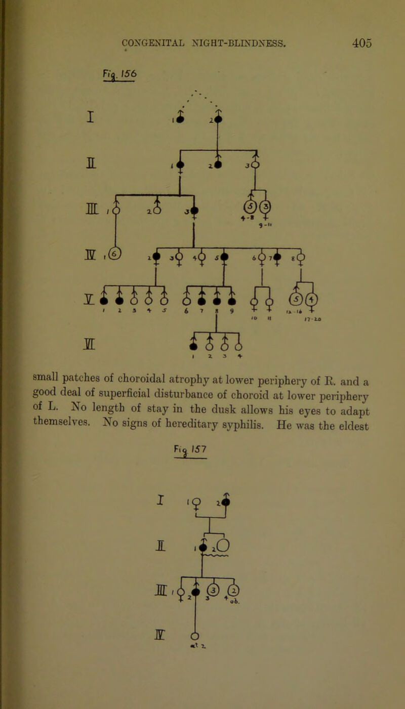 Fig, >56 small patches of choroidal atrophy at lower periphery of R. and a good deal of superficial disturbance of choroid at lower periphery of L. No length of stay in the dusk allows his eyes to adapt themselves. No signs of hereditary syphilis. He was the eldest I I JE E 6