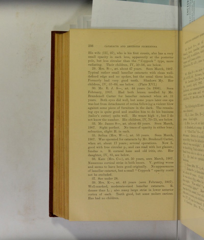 His wife (III, 37), who is his first cousin, also has a very small opacity in each lens, apparently at the posterior pole, but less circular than the “ Coppock ” type, more radiating. Their children, IV, 50-56, see below. 29. Mrs. B—, a?t. about 47 years. Seen March, 1907. Typical rather small lamellar cataracts with clean well- defined edge and no spokes, but the usual three knobs. Formerly had very good teeth. Shadows My. Her children, IV, 57-69, see below. (Plate XVI.) 30. Mr. E. ,1. S—, let. 44 years (in 1906). Seen February, 1907. Had both lenses needled by Mr. Brundenell Carter for lamellar cataract when a?t. 11 years. Both eyes did well, but some years later one eye was lost from detachment of retina following a violent blow against some piece of furniture in the dark. The remain- ing eye is quite good and enables him to do his business (tailor’s cutter) quite well. He wears high +, but I do not know the number. His children, IV, 70—75, see below. 33. Mr. James S—, a?t. about 65 years. Seen March, 1907. Sight perfect. No trace of opacity in either lens; refraction, slight H. in each. 35. Selina (Mrs. W—), a?t. 53 years. Seen March, 1907. Was operated for cataracts by Mr. Brudenell Carter, when set. about 17 years; several operations. Now L. good with free circular p., and can read with her glasses; fundus n. B. corneal haze and old iritis, etc. Her daughter, IV, 85, see below. 36. Kate (Mrs. C—), a?t. 50 years, seen March, 1907. Numerous cortical stria? in both lenses. V. getting worse and seems to have been good originally. No appearances of lamellar cataract, but a small “ Coppock ” opacity could not be excluded. 37. See under 28. 39. Mrs. K—, let. 43 years (seen February, 1907). Well-marked, moderate-sized lamellar cataracts. B. denser than L. ; also many large stria? in lower anterior cortex of each. Teeth good, but some molars carious. Has had no children.