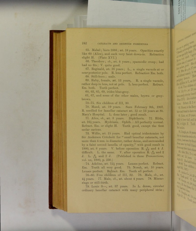 (>5. Mabel; born 1888; let. 18 years. Opacities exactly like GO (Alice), and each very faint down-in. Refraction slight H. (Plate XVI.) 66. Theodore; ob., a?t. 4 years; spasmodic croup ; had had no fits; V. quite good. 67. Reginald, jet. 16 years; L., a single vacuole at or near posterior pole. R. lens perfect. Refraction Em. both. 68. Still-born; male. 69. Ruby, female, jet. 13 years, R. a single vacuole, rather deep in lens, not at pole. L. lens perfect. Refract. Em. both. Teeth perfect. 60, 63, 65, 69, irides blue-grey. 61, 67, and some of the other males, brown or grey- brown. 70—75. Six children of III, 30. 70. Maud, jet. 19 years. Seen February 9th, 1907. R. needled for lamellar cataract jet. 12 or 13 years at St. Mary’s Hospital. L. done later ; good result. 71. Alice, ob., jet. 3 years. Diphtheria. 72. Hilda, jet. 161 years. Mydriasis. Ophth. : All perfectly normal. Refract. Em. or slight H. Teeth good, except the first molar carious. 73. Willie, set. 15 years. Had optical iridectomies by Sir Anderson Critchett for “ small lamellar cataracts, not more than I mm. in diameter, rather dense, and surrounded by a faint second lamella of opacity,” with good result in 1900, jet. 8 years. V. before operation R. and 4 J. difficult. L. the same. V. after operation R. -/V an(l 2 J. L. j-’g and 2 J. (Published in these Transactions, vol. xx, 1900, p. 230.) 74. Adeline, ait. 121 years. Lenses perfect. Refract. Em. Teeth all very good. 75. Norah, mt. 10 years. Lenses perfect. Refract. Em. Teeth all perfect. 76—80. Five children of III, 32. 76. Male, ob., set. 4.| years. 77. Male, ob., get. about 4 years. 78. Miscar- riage or still-birth. 79. Louis S—, let. 37 years. In L. dense, circular ordinary lamellar cataract with many peripheral stria:;