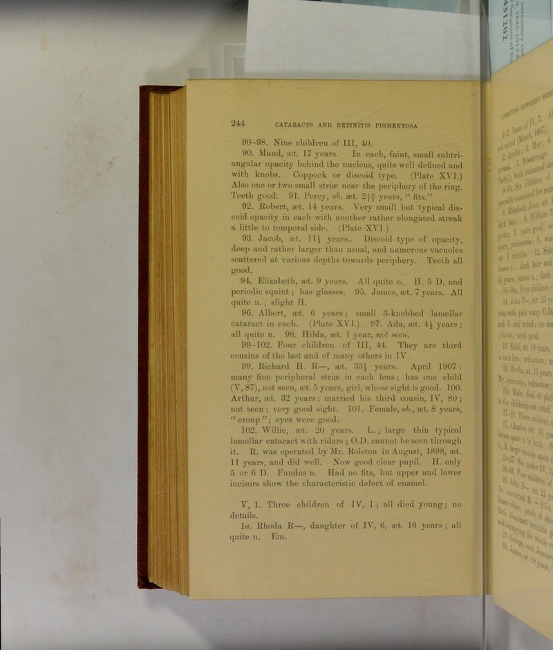 V»!l. W''- ' ■ 244 CATARACTS AND RETINITIS PIGMENTOSA 90-98. Nine children of III, 40. 90. Maud, ait. 17 years. In each, faint, small subtri- angular opacity behind the nucleus, quite well defined and with knobs. Coppock or discoid type. (Plate XVI.) Also one or two small striae near the periphery of the ring. Teeth good. 91. Percy, oh. set. 2}J years, “ fits.” 92. Robert, tet. 14 years. Very small but typical dis- coid opacity in each with another rather elongated streak a little to temporal side. (Plate XVI.) 93. Jacob, ad. 114 years.. Discoid type of opacity, dee]> and rather larger than usual, and numerous vacuoles scattered at various depths towards periphery. Teeth all good. 94. Elizabeth, a>t. 9 years. All quite n. U. 5 D. and periodic squint ; has glasses. 95. James, ait. 7 years. All quite n. ; slight 11. 90. Albert, tet. 0 years; small 3-knobbed lamellar cataract in each. (Plate XVI.) 97. Ada, mt. 4.) years; all quite n. 98. Hilda, ;et. 1 year, not seen. 99—102. Four children of III, 44. They are third cousins of the last and of many others in IV. 99. Richard II. R—, let. 33J years. April 1907 : many fine peripheral stria) in each lens; has one child (V, 87), not seen, set. 5 years, girl, whose sight is good. 100. Arthur, ast. 32 years; married his third cousin, IV, 80; not seen ; very good sight. 101. Female, oh., a)t. 8 years, “croup”; eyes were good. 102. Willie, a?t. 20 years. L.; large thin typical lamellar cataract with riders ; O.l). cannot be seen through it. R. was operated by Mr. Rolston in August, 1898, mt. 11 years, and did well. Now good clear pupil. II. only 5 or 6 D. Fundus n. Had no fits, but upper and lower incisors show the characteristic defect of enamel. i V, 1. Three children of IV, 1 ; all died young; no details. In. Rhoda R—, daughter of IV, 6, set. 16 years ; all quite n. Em.