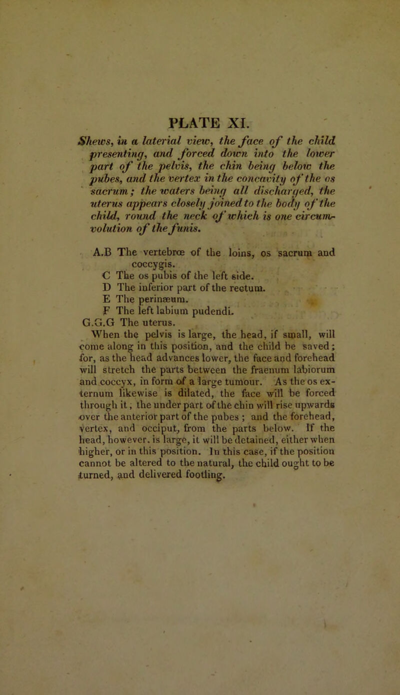 Shews, in a laterial vietc, the face of the child presenting, and forced down into the lower part of the pelvis, the chin being below the pubes, and the vertex in the concavity of the os sacrum; the waters being all discharged, the uterus appears closely joined to the body of the child, round the neck ofwhieh is one circunin volution of the funis. A.B The vertebroe of the loins, os sacrum and coccygis. C The os pubis of the left side. D The inferior part of the rectum. E The perinaeuru. F The left labium pudendL G.G.G The uterus. When the pelvis is large, the head, if small, will come along in this position, and the child be saved; for, as the head advances lower, the face and forehead will stretch the parts between the fraenum labiorum and coccyx, in form of a large tumour. As the os ex- ternum likewise is dilated, the face will be forced through it, the under part of the chin will rise upwards over the anterior part of the pubes ; and the forehead, vertex, and occiput, from the parts below. If the head, however, is large, it will be detained, either when higher, or in this position. In this case, if the position cannot be altered to the natural, the child ought to be turned, and delivered footling.