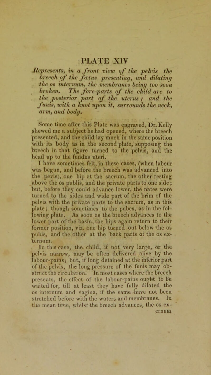 Represents, in a front vine of the pelvis the breech of the feetus presenting, and dilating the os internum, the membranes being too soon broken. The fore-parts of the child are to the posterior part of the uterus ; and the funis, with a knot upon it, surrounds the neck, arm, and body. Some time after this Plate was engraved, Dr.Kelly shewed me a subject he had opened, where the breech presented, and the child lay much in the same position with its body as in the second plate, supposing the breech in that figure turned to the pelvis, and the head up to the fundus uteri. 1 have sometimes felt, in these cases, (when labour was begun, and before the breech was advanced into the pevis), one hip at the sacrum, the other resting above the os publis, and the private parts to one side; but, before they could advance lower, the nates were turned to the sides and wide part of the brim of the pelvis with the private parts to the sacrum, as in this plate; though sometimes to the pubes, as in the fol- lowing plate. As soon as the breech advances to the lower part of the basin, the hips again return to their former position, viz. one hip turned out below the os pubis, and the other at the back parts of the os ex- ternum. In this case, the child, if not very large, or the pelvis narrow, may be often delivered alive by the labour-pains; but, if long detained at the inferior part of the pelvis, the long pressure of the funis may ob- struct the circulation. In most cases where the breech presents, the effect of the labour-pains ougltf to be waited for, till at least they have fully dilated the os internum and vagina, if the same have not been stretched before with the waters and membranes. In the mean time, wh'lst the breech advances, the os ex- ernum
