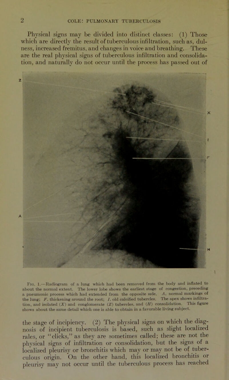 Physical signs may be divided into distinct classes: (1) Those which are directly the result of tuberculous infiltration, such as, dul- ness, increased fremitus, and changes in voice and breathing. These are the real physical signs of tuberculous infiltration and consolida- tion, and naturally do not occur until the process has passed out of Fig. 1.—HiidioKrum of a Iuhr which had Ijcen removed from the botiy and inflated to about the normal extent. The lower lobe shows the earliest sUuce of congestion, preceding a pneumonic process which had extended from the opposite side. A, normal markings of the lung; F, thickening around the root; /, old calcified tubercles. The ni>ex shows infiltra- tion, and isolated (A”) and conglomerate (Z) tubercles, and (//) consolidation. This figure shows about the same detail which one is able to obtain in a favorable living subject. the stage of incipiency. (2) The physical signs on which the diag- nosis of incipient tuberculosis is based, such as slight localized rales, or “clicks,” as they are sometimes called; these are not the physical signs of infiltration or consolidation, but the signs of a localized pleurisy or bronchitis which may or may not be of tuber- culous origin. On the other hand, this localized bronchitis or pleurisy may not occur until the tuberculous process has reached