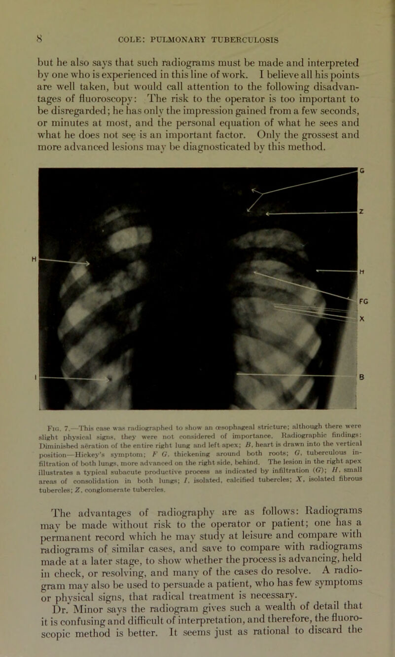 but he also says that such radiograms must be made and interpreted by one who is experienced in this line of work. I believe all his points are well taken, but would call attention to the following disadvan- tages of fluoroscopy: The risk to the operator is too important to be disregarded; he has only the impression g-ained from a few seconds, or minutes at most, and the personal equation of what he sees and what he does not see is an important factor. Only the grossest and more advanced lesions may be diagnosticated by this method. Fig. 7.—ThU case was radioKrapheil to show an rcsophaiteal stricture; although there were sliKht ph>*aical sifpis, they were not considered of importance. Radiographic findinfts: Diminishetf adration of the entire riitht lunit luid left apex; /f, heart is drawn into the vertical position—Hickey’s symptom; F G, thickening around both roots; G, tulierculous in- fUtration of both lungs, more advanced on the right side, liehind. The lesion in the right apex illustrates a typical subacute productive process as indicated by infiltration (C); //. small areas of consolidation in both lungs; /, isolated, calcified tubercles; A, isolated fibrous tubercles; Z, conglomerate tubercles. The advantages of nidiography are as follows: Radiograms may be made without risk to the operator or patient; one has a permanent record which he may study at leisure and compiire with radiograms of similar cases, and save to compare with radiograms made at a later stage, to show whether the process is advancing, held in check, or resolving, and many of the cases do resolve. A radio- gram mav also be used to persuade a patient, who has few symptoms or physical signs, that radical treatment is necessary. Dr. Minor says the radiogram gives such a wealth of detail that it is confusing and difficult of interpretation, and therefore, the fluoro- scopic method is better. It seems just as rational to discard the