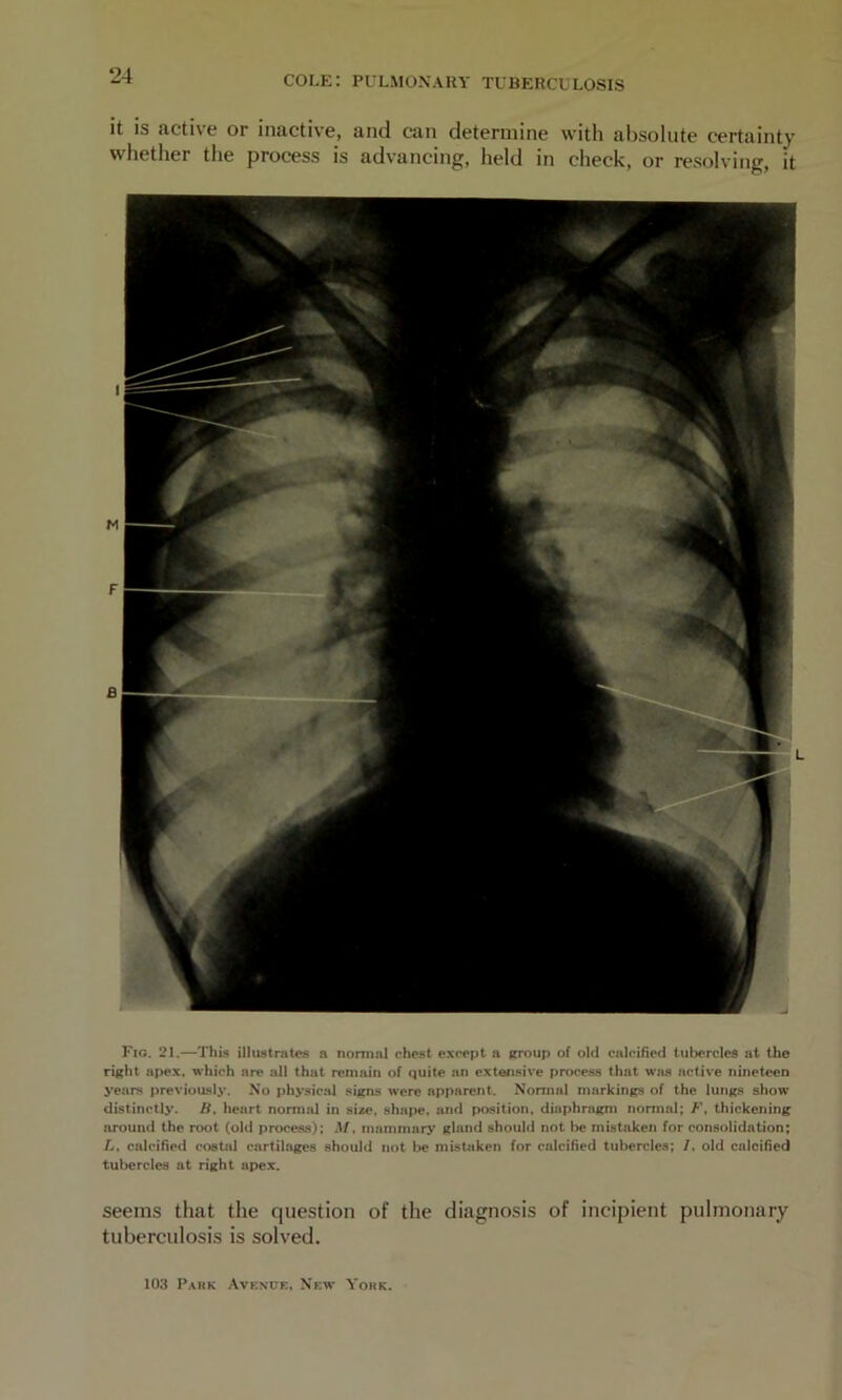 it is active or inactive, and can determine with absolute certainty whether the process is advancing, held in check, or resolving, it Fig. 21.—This illustratos a normal chest except a frroup of old calcified tubercles at the right apex, which are all that remain of quite an extensive process that wjus active nineteen years previously. No physical signs were apparent. Nonnnl markings of the lungs show distinctly. B, heart nomud in size. sha|>e, and position, diaphragm normal; F, thickening around the root (old process); M. mammary gland should not be mistaken for consolidation; //, calcified costjd cartilages should not be mistaken for calcified tubercles; /. old calcified tubercles at right apex. seems that the question of the diagnosis of incipient pulmonary tuberculosis is solved. 103 Pahk Avenue, New Yoke.