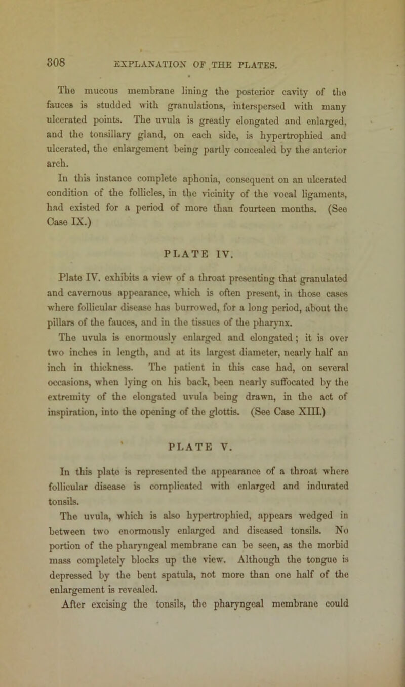 The mucous membrane lining the posterior cavity of the fauces is studded with granulations, interspersed with many ulcerated points. The uvula is greatly elongated and enlarged, and the tonsillary gland, on each side, is hypertrophied and ulcerated, the enlargement being partly concealed by the anterior arch. In this instance complete aphonia, consequent on an ulcerated condition of the follicles, in the vicinity of the vocal ligaments, had existed for a period of more than fourteen months. (See Case IX.) PLATE IV. Plate IV. exhibits a view of a tliroat presenting that granulated and cavernous appearance, which is often present, in tliose cases where follicular disease has burrowed, for a long period, about tlie pillars of tlie fauces, and in the tissues of the pharynx. The uvula is enormously enlarged and elongated; it is over two inches in length, and at its largest diameter, nearly half an inch in thickness. The patient in this case had, on several occasions, when lying on his back, been nearly suffocated by tlie extremity of the elongated uvula being drawn, in tlie act of inspiration, into the opening of the glottis. (See Case XIII.) • PLATE V, In this plate is represented the appearance of a throat where follicular disease is complicated with enlarged and indurated tonsils. The uvula, whieh is also hypertrophied, appears wedged in between two enormously enlarged and diseased tonsils. No portion of the phaiyngeal membrane can be seen, as the morbid mass completely blocks up the view. Although the tongue is depressed by the bent spatula, not more than one half of the enlargement is revealed. After excising the tonsils, Uie pharyngeal membrane could