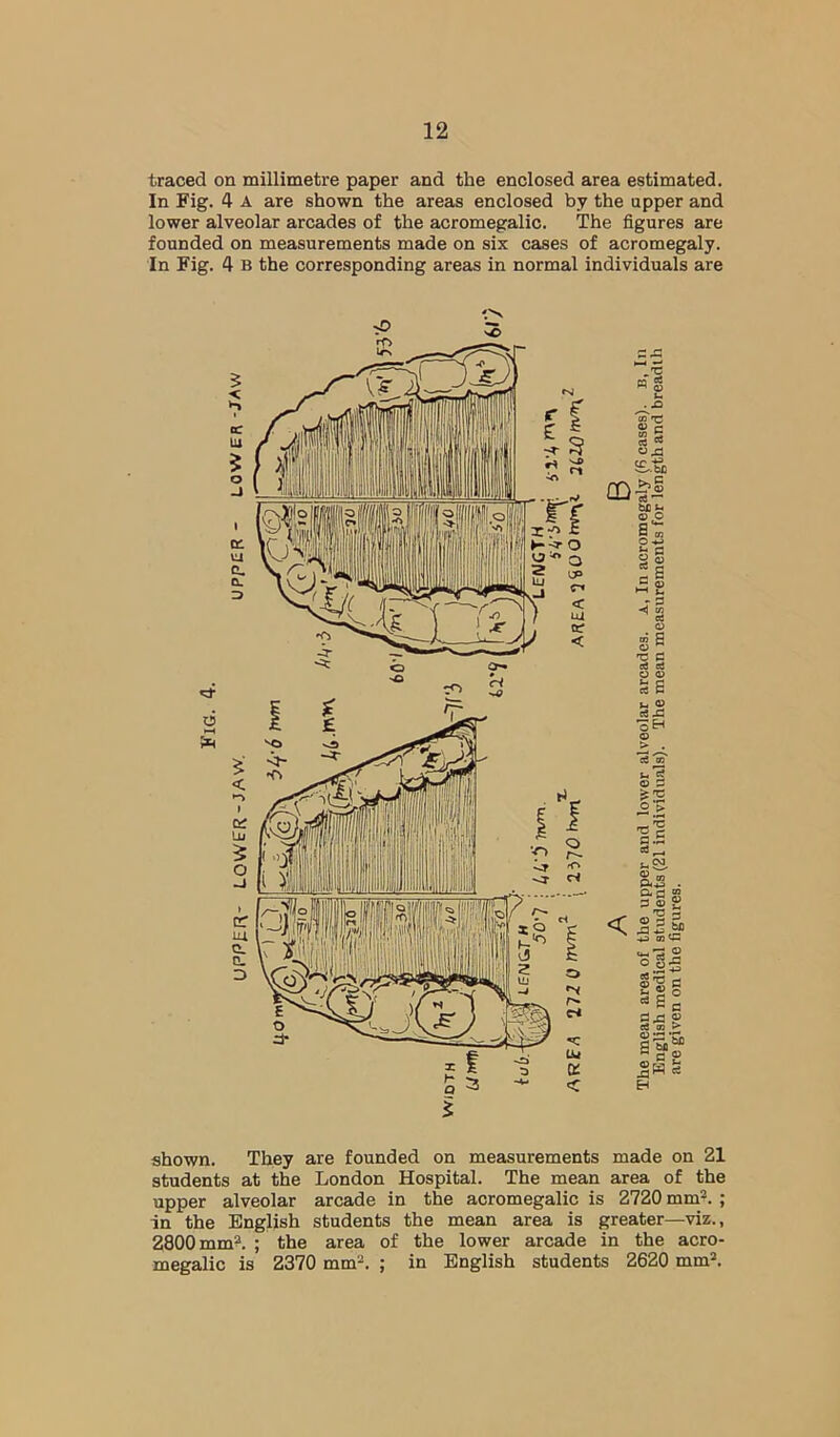 traced on millimetre paper and the enclosed area estimated. In Fig. 4 A are shown the areas enclosed by the upper and lower alveolar arcades of the acromegalic. The figures are founded on measurements made on six cases of acromegaly. In Fig. 4 b the corresponding areas in normal individuals are .■c CO 0) c d* © P o ^ S © j- -t) m C6 O 03 S o ^ 'C C (d ed O (D u © ei Si 9 c3 to 9 ^ °!E n- ^ B.S c3 ^ < ft® . §■§£ 3 03 S'! (5 t- © o ^ s fi  ’hn ® c g shown. They are founded on measurements made on 21 students at the London Hospital. The mean area of the upper alveolar arcade in the acromegalic is 2720 mm^. ; in the English students the mean area is greater—viz., 2800 mm?. ; the area of the lower arcade in the acro- megalic is 2370 mm“. ; in English students 2620 mm*.