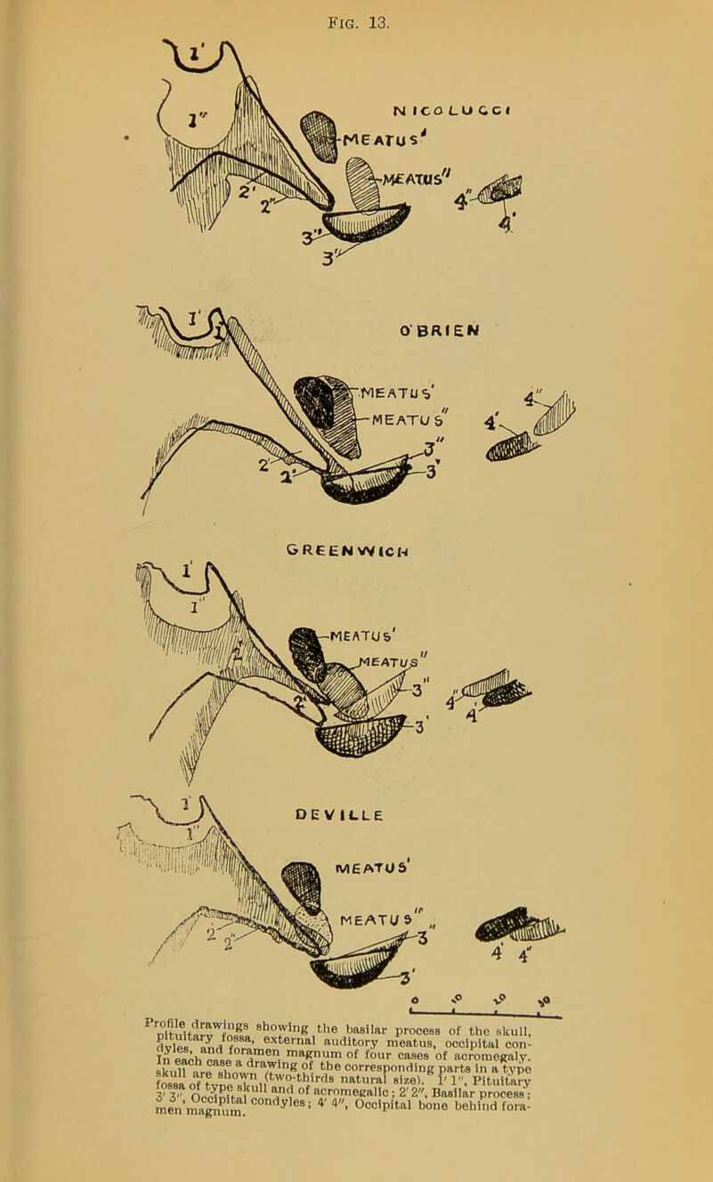 GR6EN VVICW Showing the basilar process of the skull, dvles auditory meatus, occipital con- In P^h of four cases of acromegaly, skull ar^8hnu^w7 j*’® corresponding parts in a typo fos^aof tvnn «V. natural size). 1' I. Pituitaly 3°3  OeHnttn^^” “cromegallc; 2' 2, Basilar process; menmagnC “°‘’'^'®®= ' ^ »^®® behind fora: