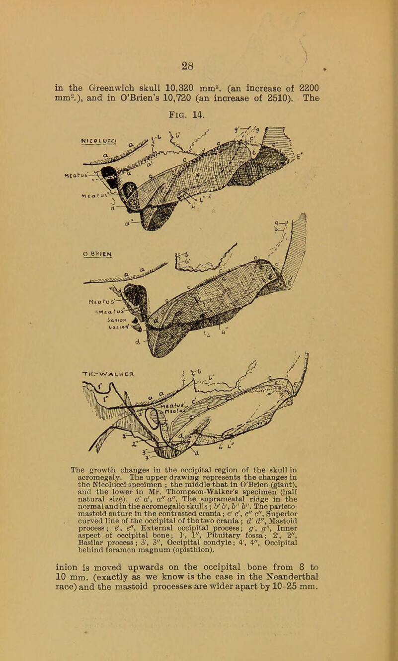 in the Greenwich skull 10,320 mm*, (an increase of 2200 mm*.), and in O’Brien’s 10,720 (an increase of 2510). The Fig. W. The growth changes in the occipital region of the skull in acromegaly. The upper drawing represents the changes in the Nicolucci specimen ; the middle that in O’Brien (giant), and the lower in Mr. Thompson-Walker’s specimen (half natural size), a' o', a a. The suprameatal ridge in the normal and in the acromegalic skulls; V b', b b. The parieto- mastoid suture in the contrasted crania; c' c', c c, Superior curved line of the occipital of the two crania; d'd, Mastoid process; e', e. External occipital process; g', g, Inner aspect of occipital bone; ]', 1, Pituitary fossa; 2', 2, Basilar process; 3', 3, Occipital condyle; 4’, 4, Occipital behind foramen magnum (opisthion). inion is moved upwards on the occipital bone from 8 to 10 mm. (exactly as we know is the case in the Neanderthal race) and the mastoid processes are wider apart by 10-25 mm.