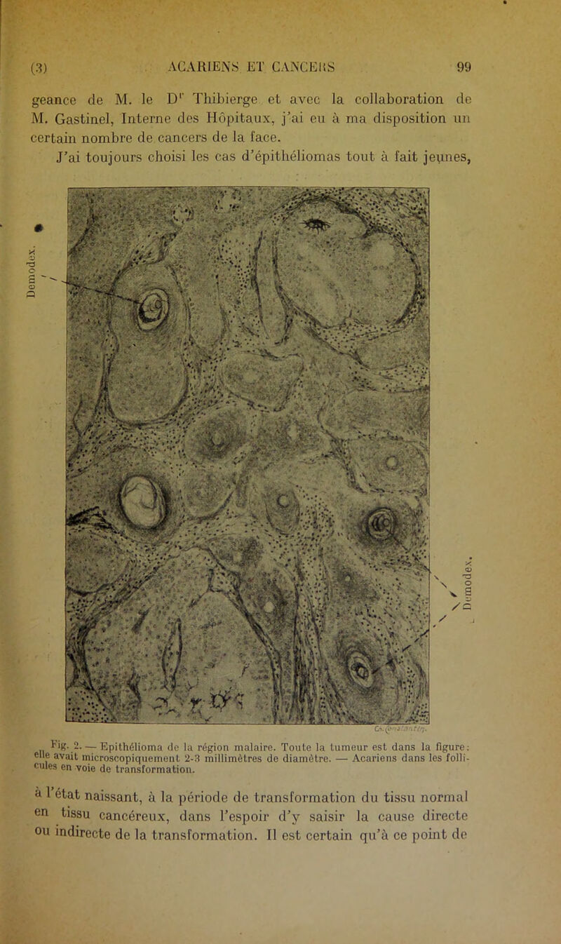 Demodex. geance de M. le D'' Thibierge et avec la collaboration de M. Gastinel, Interne des Hôpitaux, j’ai eu à ma disposition un certain nombre de cancers de la face. J’ai toujours choisi les cas d’épitliéliomas tout à fait jeunes, Fig. 2—Epithélioma de la région malaire. Toute la tumeur est dans la figure; elle avait microscopiqueineiiL 2-3 millimètres de diamètre. — Acariens dans les folli- cules en voie de transformation. à 1 état naissant, à la période de transformation du tissu normal en tissu cancéreux, dans l’espoir d’y saisir la cause directe ou indirecte de la transformation. Il est certain qu’à ce point do Demodex