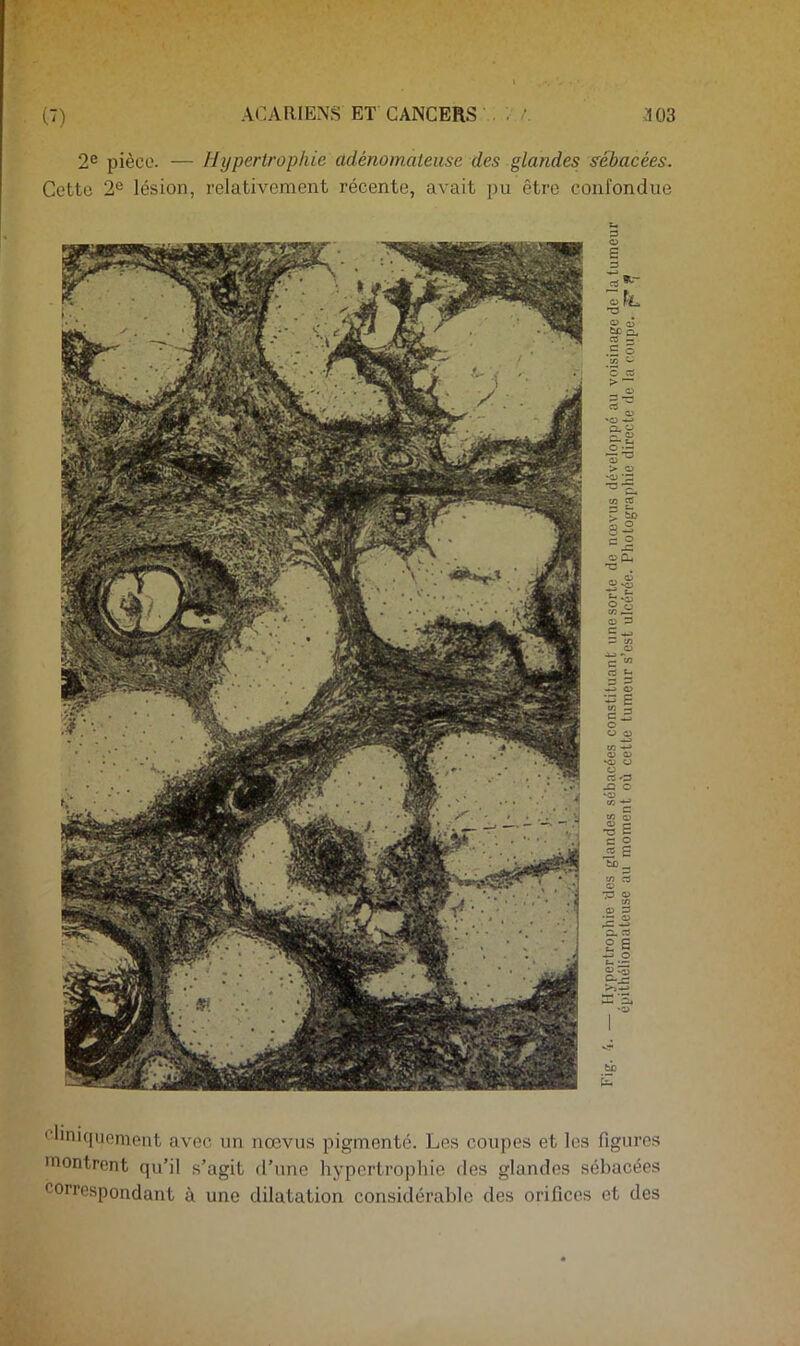 2*^ pièce. — Hypertrophie adénomateuse des glandes sébacées. Cette 2® lésion, relativement récente, avait pu être confondue elinicpienient avec un nœviis pigmenté. Les coupes et les figures montrent qu’il s’agit d’une hypertrophie des glandes sébacées correspondant à une dilatation considérable des orifices et des O fi. O c5 tp CL. C5 — S ® rt '3 O W O T3 C = 2 iS Ê îiû - 0.3