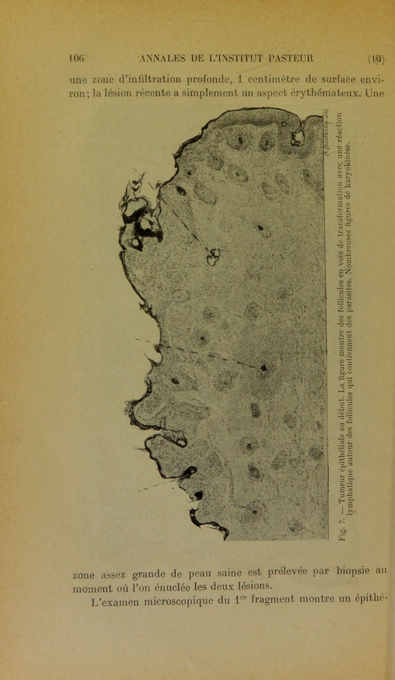 une zone d’infiltration profonde, 1 centimètre de surface envi- ron; la lésion récente a simplement un aspect érythémateux. Une zone assez grande de peau saine est prélevée par biopsie au moment où l’on énuclée les deux lésions. L’examen microscopique du 1 fragment montre un épithé-
