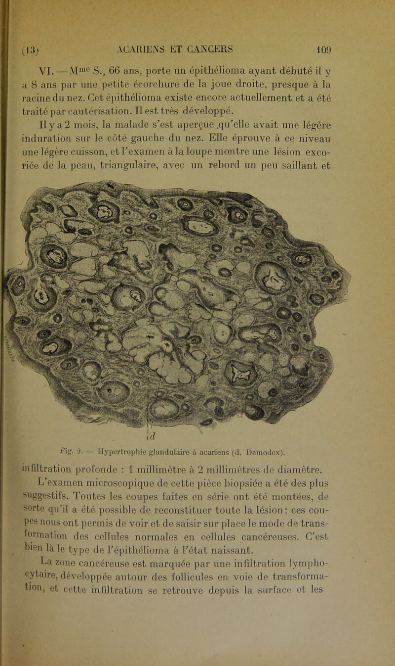 0-T; VI. — iM'*-' S., 66 ans, porte nn épithélioma ayant débuté il y a 8 ans par une petite écorchure de la joue droite, presque à la racine du nez. Cet épithélioma existe encore actuellement et a été traité ])ar cautérisation. II est très développé. Ilya2 mois, la malade s’est aperçue .qu’elle avait une légère induration sur le côté gauche du nez. Elle éprouve à ce niveau une légère cuisson, et l’examen à la loupe montre une lésion exco- riée de la peau, triangulaire, avec un rebord un peu saillant et fig. 0. — Ilypertropliie glandulaire à acariens (d. Demodex). infiltration profonde : 1 millimètre à 2 millimètres de diamètre. L’examen microscopique de cette pièce biopsiée a été des plus 'suggestifs. Toutes les coupes faites en série ont été montées, de sorte qu’il a été possible de reconstituer toute la lésion; ces cou- pes nous ont permis de voir et de saisir sur place le mode de trans- formation dos cellules normales en cellules cancéreuses. C’est bien là le type de l’épithélioma à l’état naissant. La zone cancéreuse est marquée par une infiltration lympho- cytaire, développée autour des follicules en voie de transforma- Lon, et cette infiltration se retrouve depuis la surface et les