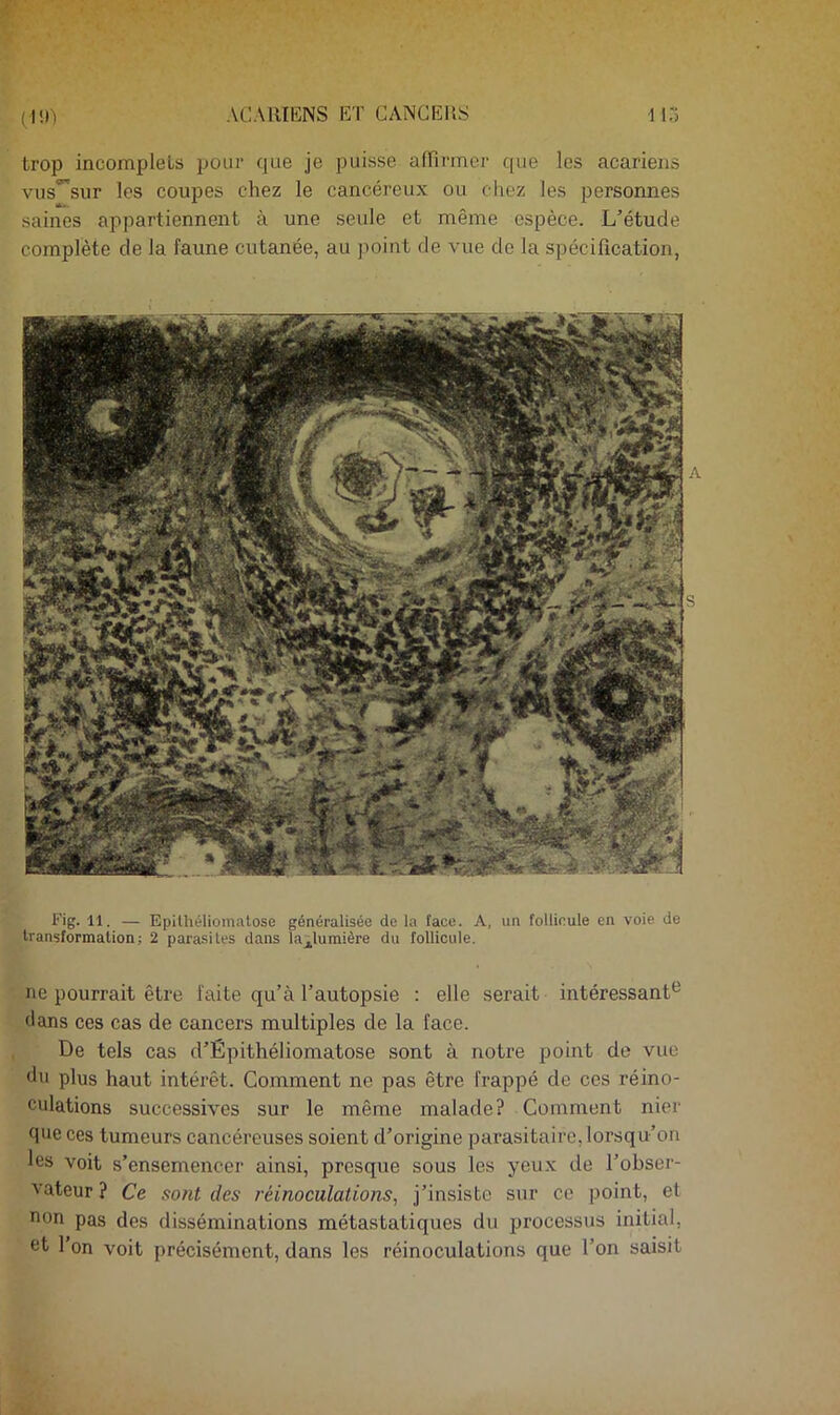 (MO trop incomplets pour que je puisse affirmer que les acariens vus'^sur les coupes chez le cancéreux ou chez les personnes saines appartiennent à une seule et même espèce. L’étude complète de la faune cutanée, au jmint de vue de la spécification, Fig. 11, — Epithéliomalose généralisée de la face. A, un follicule en voie de transformation; 2 para-sites dans la^lumière du follicule. ne pourrait être faite qu’à l’autopsie : elle serait intéressant*^ <lans ces cas de cancers multiples de la face. De tels cas d’Épithéliomatose sont à notre point do vue *'>i plus haut intérêt. Comment ne pas être frappé de ces réino- culations successives sur le même malade? Comment nier fine ces tumeurs cancéreuses soient d’origine parasitaire, lorsqu’on les voit s’ensemencer ainsi, presque sous les yeux de l’obser- vateur ? Ce sont des réinoculations, j’insiste sur ce point, et non pas des disséminations métastatiques du processus initial, et l’on voit précisément, dans les réinoculations que l’on saisit