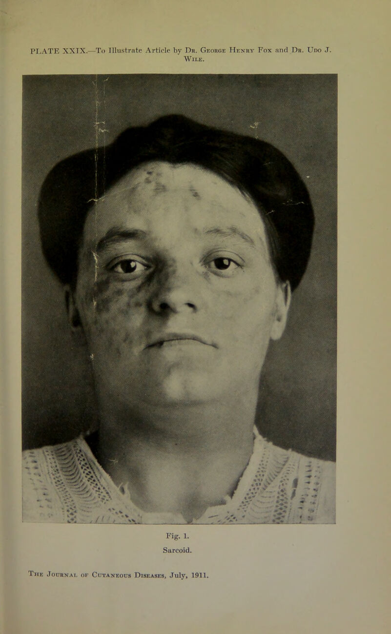 PLATE XXIX.-—To Illustrate Article by Dr. George Henry Fox and Dr. Uno J. Wile. Fig. 1. Sarcoid. The Journal of Cutaneous Diseases, July, 1911.