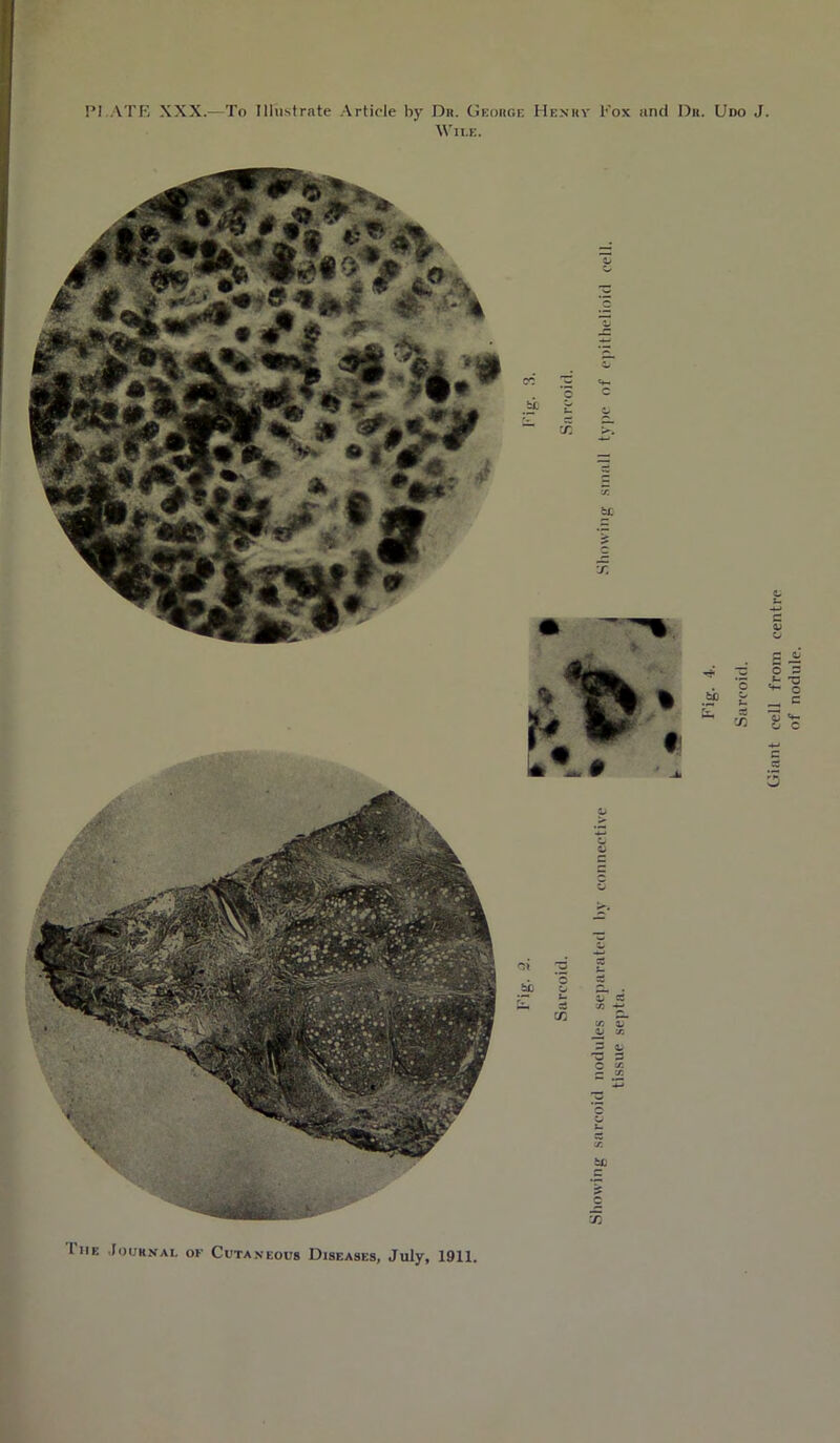 PI.ATB XXX.—To Illustrate Article by Dn. George Henuv Fox and Dr. Udo J. Wile. Giant cell from centre of nodule.