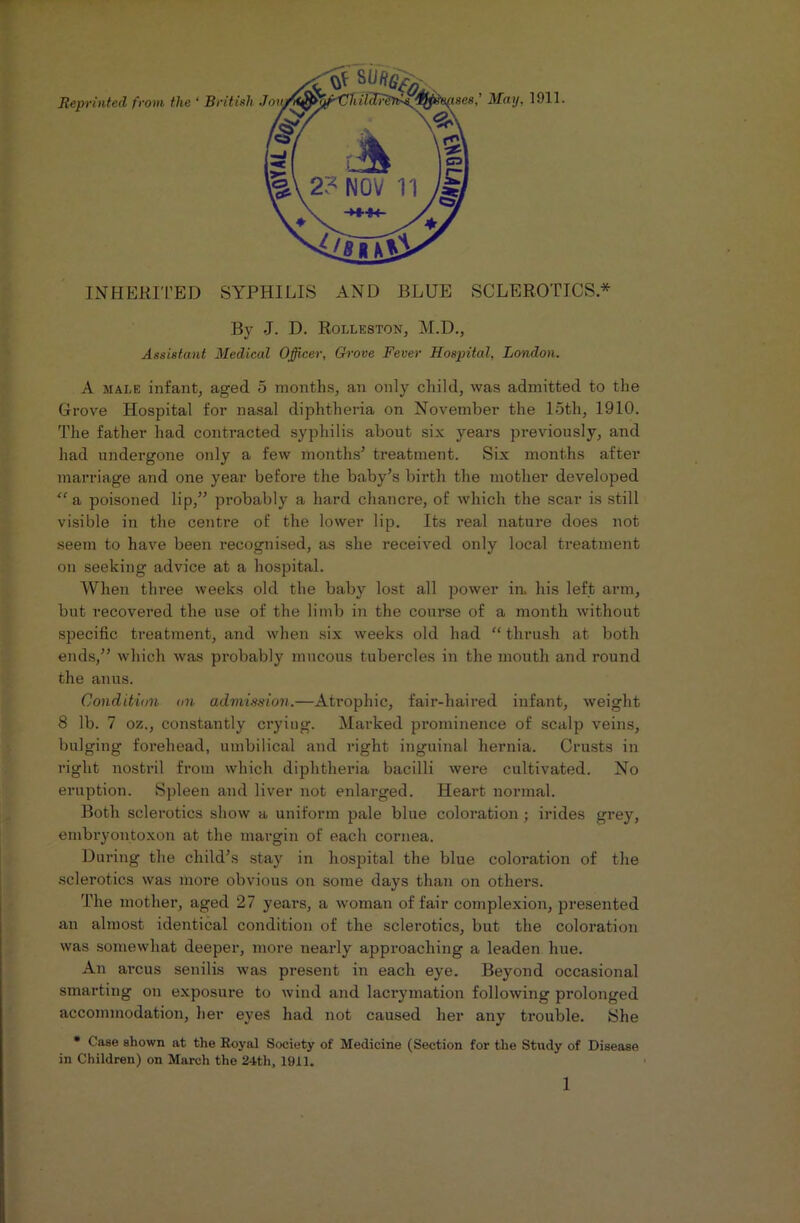 By -J. D. Rolleston, M.D., Assistant Medical Officer, Grove Fever Hospital, London. A male infant, aged 5 months, an only child, was admitted to the Grove Hospital for nasal diphtheria on November the loth, 1910. The father had contracted syphilis about six years previously, and had undergone only a few months’ treatment. Six months after marriage and one year before the baby’s birth the mother developed “ a poisoned lip,” probably a hard chancre, of which the scar is still visible in the centre of the lower lip. Its real nature does not seem to have been recognised, as she received only local treatment on seeking advice at a hospital. When three weeks old the baby lost all power in. his left arm, but recovered the use of the limb in the course of a month without specific treatment, and when six weeks old had “ thrush at both ends,” which was probably mucous tubercles in the mouth and round the anus. Condition on admission.—Atrophic, fair-liaired infant, weight 8 lb. 7 oz., constantly crying. Marked prominence of scalp veins, bulging forehead, umbilical and right inguinal hernia. Crusts in right nostril from which diphtheria bacilli were cultivated. No eruption. Spleen and liver not enlarged. Heart normal. Botli sclerotics show a uniform pale blue coloration ; irides grey, embryontoxon at the margin of each cornea. During the child’s stay in hospital the blue coloration of the sclerotics was more obvious on some days than on others. The mother, aged 27 years, a woman of fair complexion, presented an almost identical condition of the sclerotics, but the coloration was somewhat deeper, more nearly approaching a leaden hue. An arcus senilis was present in each eye. Beyond occasional smarting on exposure to wind and laci-ymation following prolonged accommodation, her eyes had not caused her any trouble. She * Case shown at the Royal Society of Medicine (Section for the Study of Disease in Children) on March the 24th, 1911.