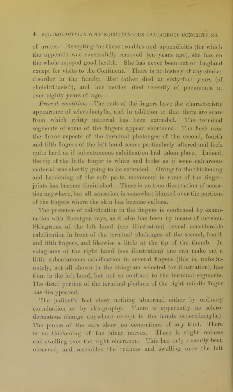 of unites. Excepting for these troubles and appendicitis (for which the appendix was successfully removed ten years ago), she has on the whole enjoyed good health. She has never been out of England except for visits to the Continent. There is no history of any similar disorder in the family. Her father died at sixty-four years (of cholelithiasis?), and her mother died recently of pneumonia at over eighty years of age. Present condition.—The ends of the fingers have the characteristic appearance of sclerodactylia, and in addition to that there are scars from which gritty material has been extruded. The terminal segments of some of the fingers appear shortened. The flesh over the flexor aspects of the terminal phalanges of the second, fourth and fifth fingers of the left hand seems particularly altered and feels quite hard as if subcutaneous calcification had taken place. Indeed, the tip of the little finger is white and looks as if some calcareous material was shortly going to be extruded. Owing to the thickening and hardening of the soft parts, movement in some of the finger- joints has become diminished. There is no true dissociation of sensa- tion anywhere, but all sensation is somewhat blunted over the portions of the fingers where the skin has become callous. The presence of calcification in the fingers is confirmed by exami- nation with Roentgen rays, as it also has been by means of incision. Skiagrams of the left hand (see illustration) reveal considerable calcification in front of the terminal phalanges of the second, fourth and fifth fingers, and likewise a little at the tip of the thumb. In skiagrams of the right hand (see illustration) one can make out a little subcutaneous calcification in several fingers (this is, unfortu- nately, not all shown in the skiagram selected for illustration), less than in the left hand, but not so confined to the terminal segments. The distal portion of the terminal phalanx of the right middle finger has disappeared. The patient’s feet show nothing abnormal either by ordinary examination or by skiagraphy. There is apparently no sclero- dermatous change anywhere except in the hands (sclerodactylia). The pinme of the ears show no concretions of any kind. There is no thickening of the ulnar nerves. There is slight redness and swelling over the right olecranon. This has only recently been observed, and resembles the redness and swelling over the left