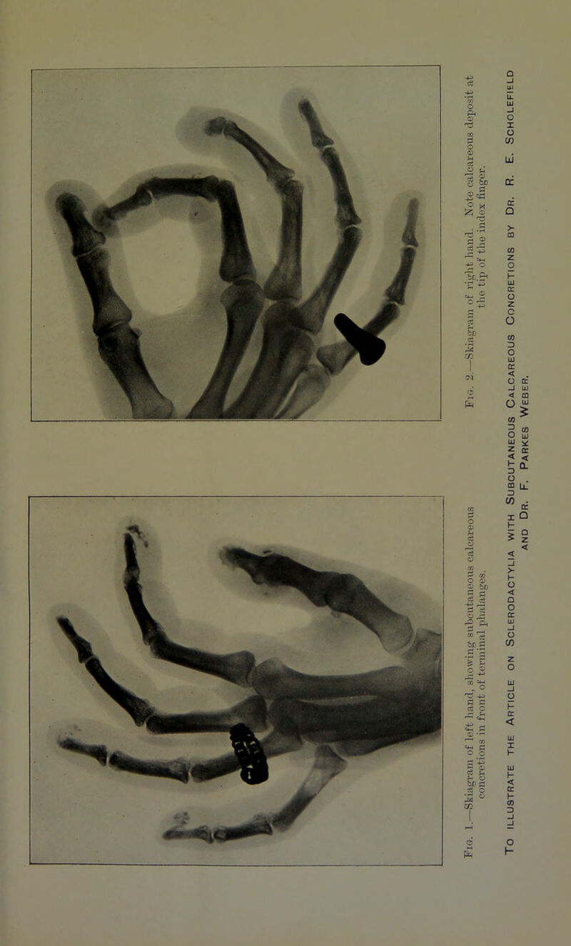 ILLUSTRATE THE ARTICLE ON SCLERODACTYLIA WITH SUBCUTANEOUS CALCAREOUS CONCRETIONS BY Dr. R. E. SCHOLEFIELD and Dr. F. Parkes Weber.