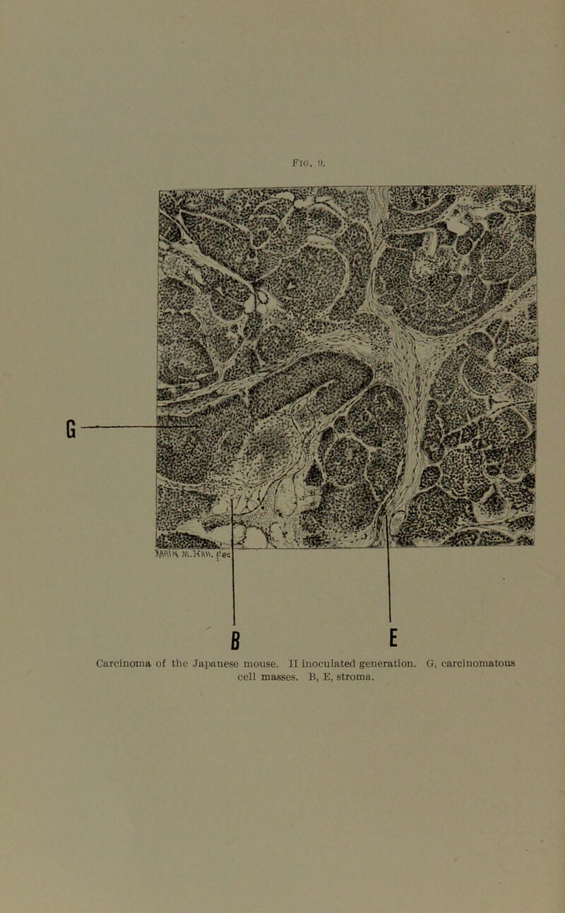 Carcinoma of the Japanese mouse. II inoculated generation. G, carcinomatous cell masses. B, E, stroma.