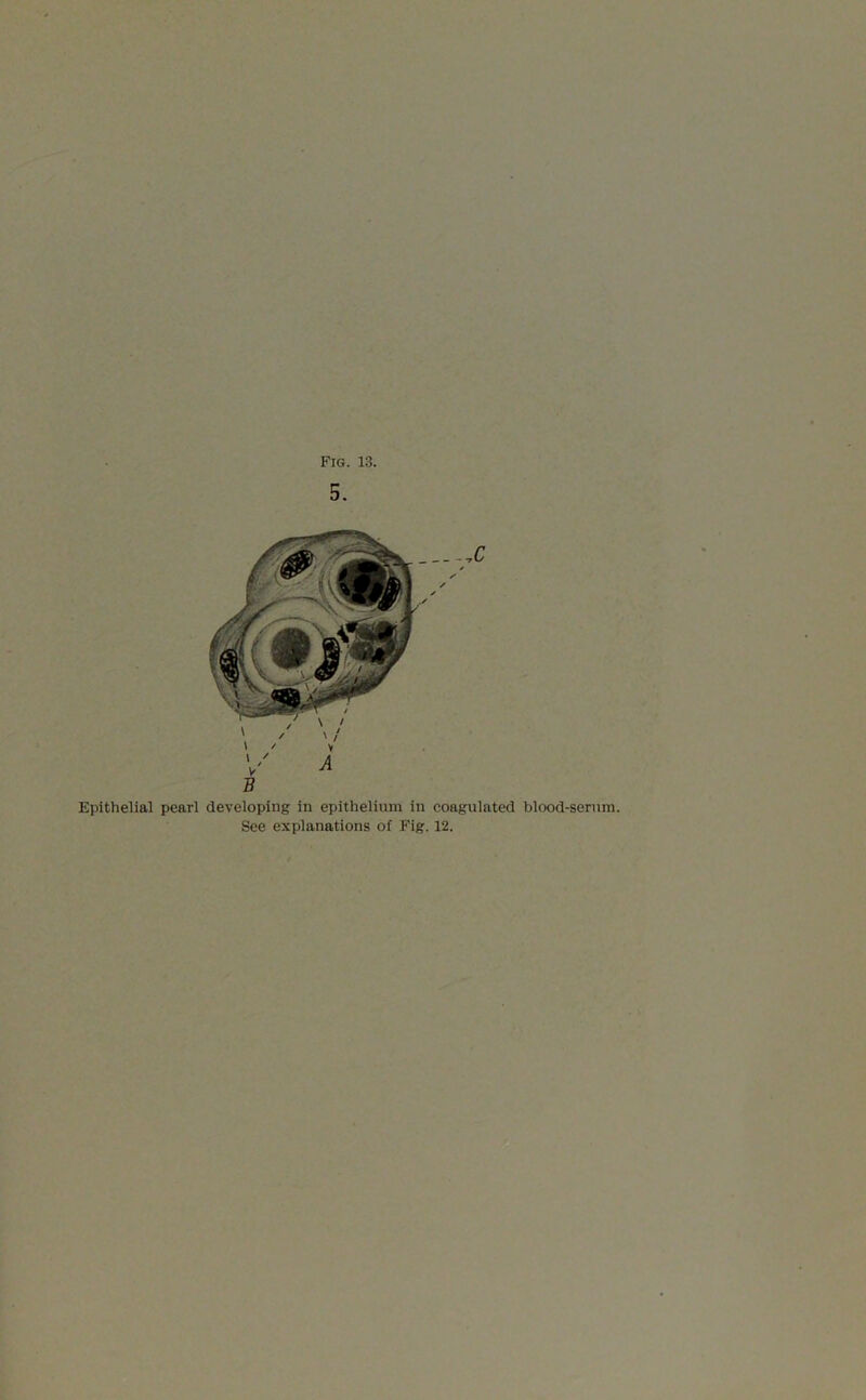 5. Epithelial pearl developing in epithelium in coagulated blood-sernm. See explanations of Fig. 12.