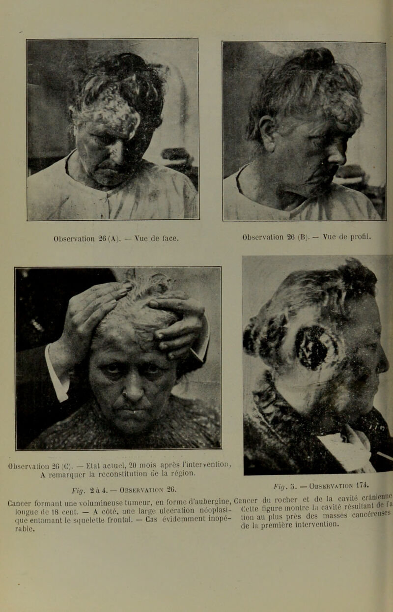 Observation 26 (A). — Vue de l'ace. Observation 26 (B). — 'Vue de prolil. Fig. 2 à -t. — ÜBStaivATio.N 26. Cancer formant une volumineuse tumeur, en forme d aubergine, longue de 18 cent. — A côté, une large ulcération néoplasi- (|ue entamant le S(iuelette frontal. — Cas évidemment inopé- rable. Fig. 5. — Observation 171. Cancer du rocher et de la cavité crânicnno Celle ligure monire la cavité résultant de > lion au plus près des masses cancéreuses de la première intervention.