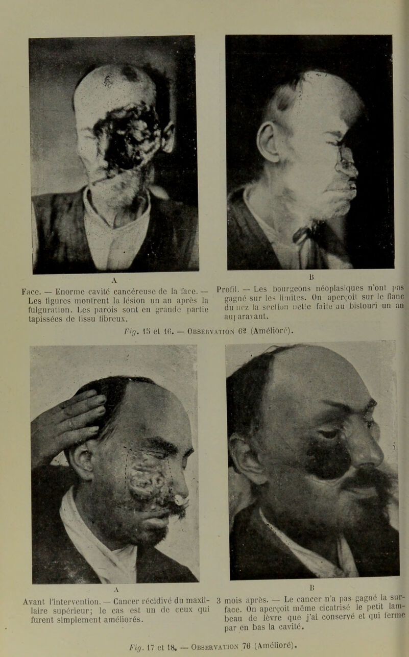 A Face. — Enorme cavité cancéreuse de la face. — Les ligures monfrent la lésion nn an après la lulguralion. Los |>arois sont en grande parli(! tapissées de lissu libreu.x. l>Pofi|, — Les bourgeons néoplasi(iues n’onl i>as gagné sur les limites. Ou apen;oil sur le liane du liez la scclioii iiotic faile au bistouri un an ail] ara\ant. Fiçi. Ui et K!. — OBSEnvATiO-N 05 (Amélioré). .V Avant Fiutervenlion. — Cancer récidivé du maxil- laire supérieur; le cas est un de ceux iiui lurent simplement améliorés. I! 3 mois après. — Le cancer n’a pas gagné la sur- face. Ün aperçoit même cicatrisé le petit lam- beau de lèvre que j’ai conservé et (lui lerinc par en bas la cavité.