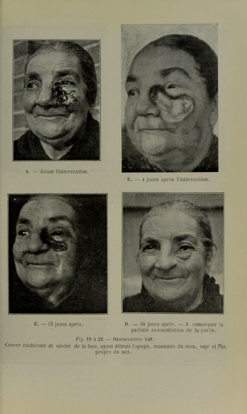 B. — l jours après l’inlerveiilion. C. — 13 jours après. D. _ ,'i6 jours après. — A lemarcjucr la parfailc rcconstitiUion de la parlie. FUj. 19 à :22. — Observation 118. Cancer exubérant et ulcéré de la lace, ayant détruit l’apoph. montante du max. sup' et l'os propre du nez.