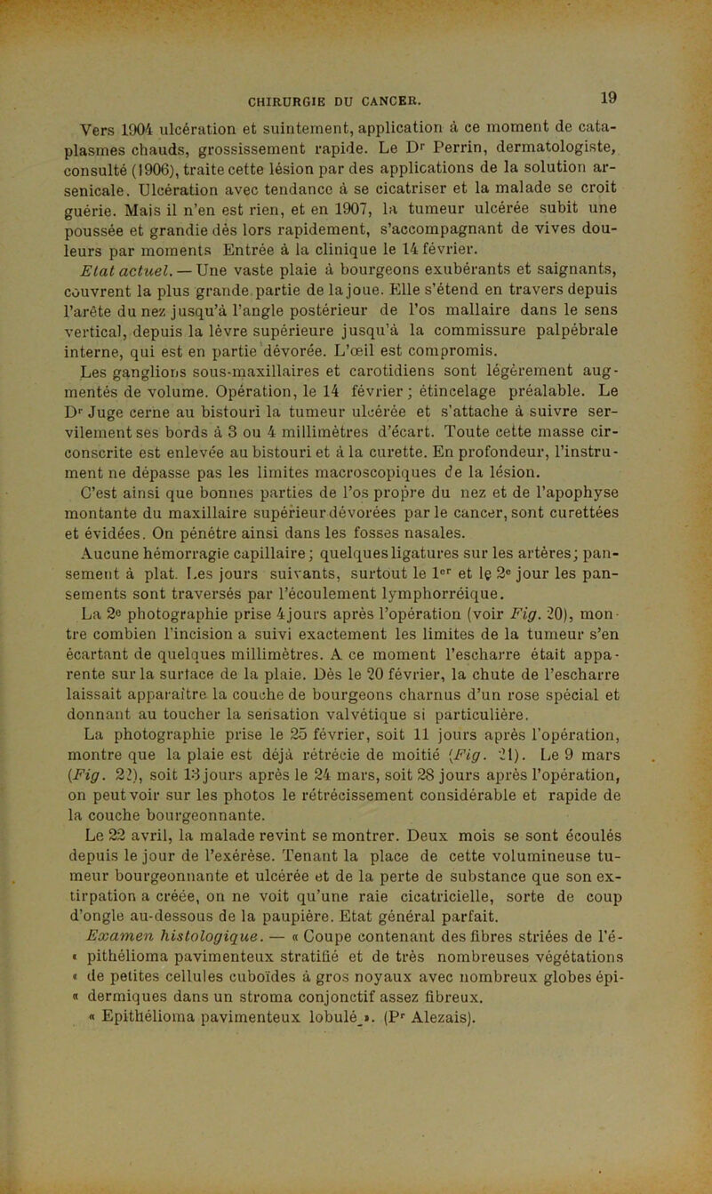 Vers 1904 ulcération et suintement, application à ce moment de cata- plasmes chauds, grossissement rapide. Le Perrin, dermatologiste, consulté (1906), traite cette lésion par des applications de la solution ar- senicale. Ulcération avec tendance à se cicatriser et la malade se croit guérie. Mais il n’en est rien, et en 1907, la tumeur ulcérée subit une poussée et grandie dès lors rapidement, s’accompagnant de vives dou- leurs par moments Entrée à la clinique le 14 février. Elat actuel. —XiwQ vaste plaie à bourgeons exubérants et saignants, couvrent la plus grande partie de lajoue. Elle s’étend en travers depuis l’arête du nez jusqu’à l’angle postérieur de l’os mallaire dans le sens vertical, depuis la lèvre supérieure jusqu’à la commissure palpébrale interne, qui est en partie'dévorée. L’œil est compromis. Les ganglions sous-maxillaires et carotidiens sont légèrement aug- mentés de volume. Opération, le 14 février; étincelage préalable. Le D'' Juge cerne au bistouri la tumeur ulcérée et s’attache à suivre ser- vilement ses bords à 3 ou 4 millimètres d’écart. Toute cette masse cir- conscrite est enlevée au bistouri et à la curette. En profondeur, l’instru- ment ne dépasse pas les limites macroscopiques de la lésion. C’est ainsi que bonnes parties de l’os propre du nez et de l’apophyse montante du maxillaire supérieur dévorées parle cancer, sont curettées et évidées. On pénétre ainsi dans les fosses nasales. Aucune hémorragie capillaire; quelques ligatures sur les artères; pan- sement à plat. Les jours suivants, surtout le 1®'' et Iç 2® jour les pan- sements sont traversés par l’écoulement lymphorréique. La 2o photographie prise 4jours après l’opération (voir Fig. 20), mon- tre combien l’incision a suivi exactement les limites de la tumeur s’en écartant de quelques millimètres. A ce moment l’escharre était appa- rente sur la surface de la plaie. Dès le 20 février, la chute de l’escharre laissait apparaître la couche de bourgeons charnus d’un rose spécial et donnant au toucher la sensation valvétique si particulière. La photographie prise le 25 février, soit 11 jours après l’opération, montre que la plaie est déjà rétrécie de moitié {Fig. 21). Le 9 mars {Fig. 22), soit 13 jours après le 24 mars, soit 28 jours après l’opération, on peut voir sur les photos le rétrécissement considérable et rapide de la couche bourgeonnante. Le 22 avril, la malade revint se montrer. Deux mois se sont écoulés depuis le jour de l’exérèse. Tenant la place de cette volumineuse tu- meur bourgeonnante et ulcérée et de la perte de substance que son ex- tirpation a créée, on ne voit qu’une raie cicatricielle, sorte de coup d’ongle au-dessous de la paupière. Etat général parfait. Examen histologique. — « Coupe contenant des fibres striées de l’é- « pithélioma pavimenteux stratifié et de très nombreuses végétations « de petites cellules cuboïdes à gros noyaux avec nombreux globes épi- « dermiques dans un stroma conjonctif assez fibreux. « Epithélioma pavimenteux lobulé_». (P® Alezais).