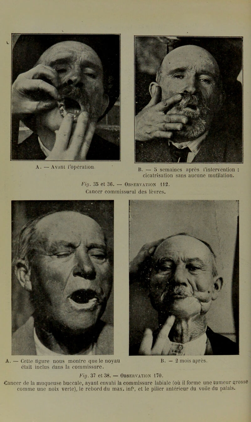cicatrisation sans aucune mutitation. Fi(j. 35 et 36. — Observation 112. r.ancer commissural des lèvres. A. — Celte tigure nous montre que le noyau ôtait inclus dans la commissure. B. — 2 mois après. Fig. 37 et 38. — Observation 170. dancer de la muqueuse buccale, ayant envahi la commissure labiale (où il forme une tumeur grosse comme une noix verte), le rebord du max. inf% et le pilier antérieur du voile du palais.