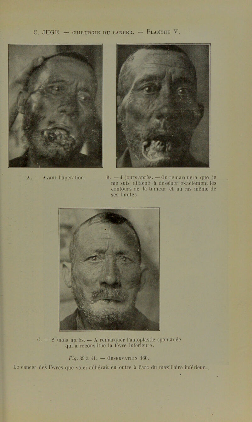 C. JUGE. — CHlRTJRGIIi: DU CANCER. — PlAMCHE V. A. — AvaiiL rolJÔralion. li. —i Jours après. — On rcmaniucra (]ue Je me suis allaché à dessiner exaclemenl les contours de la tumeur et au ras même de ses limites. 0. — 2 mois après. — A remaniucr l'auloplastie spontanée (|ui a rcconsliliié la lèvre inréricure. Fi(j. 39 à U . — Observation IGO. Le cancer des lèvres que voici adhérait en outre à l’arc du maxillaire inférieur.