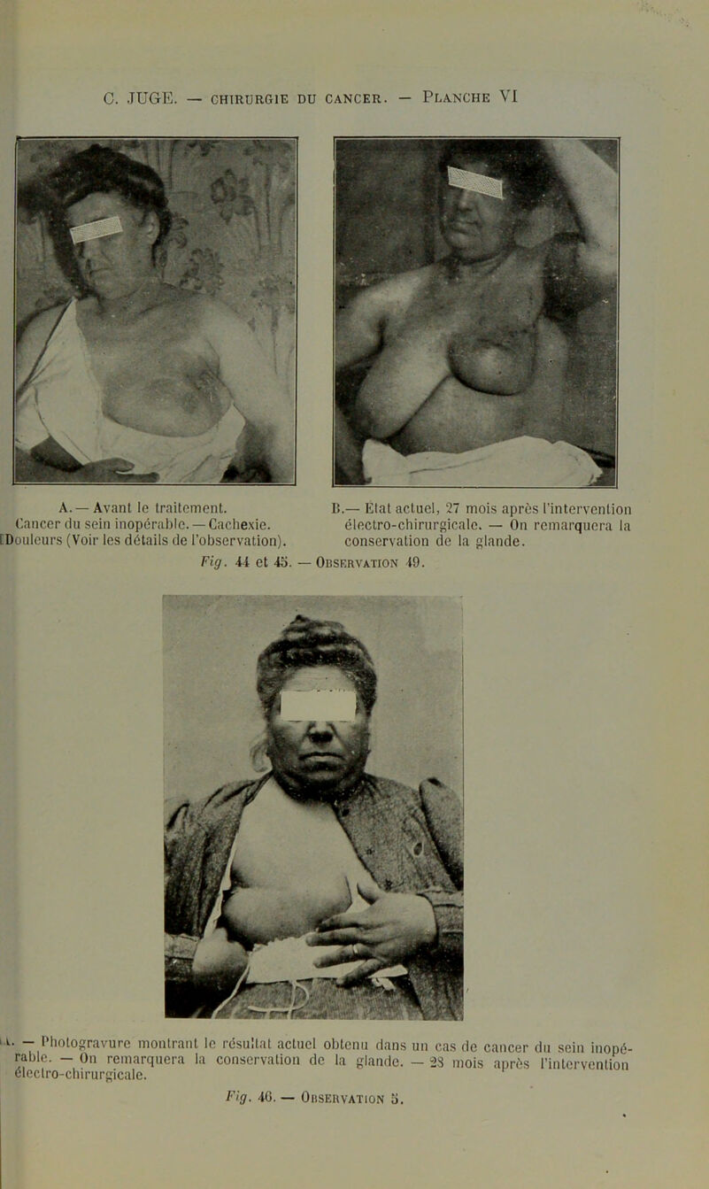A.—Avant le traitement. Cancer du sein inopérable. —Caclie.\ie. iDouleurs (Voir les détails de l’observation). Fig. 44 et 4o. — B.— État actuel, 27 mois après l’intervention électro-chirurgicale. — On remarquera la conservation de la glande. Observation 49. ‘T. — Photogravure montrant le résultat actuel obtenu dans un cas de cancer du sein inopé- rable. - On remarquera la conservation de la glande. - “23 mois après l’intervention électro-chirurgicale. Fig. 40. — Observation 5.