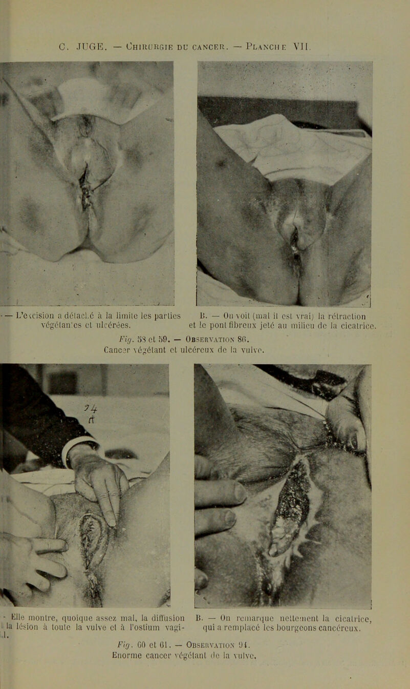 C. JUGE. — Ohiiiukgik du cancf.u. — Planche VU. — L’cvcision a délacl.6 à Ja limile les parties B. — Un voit (mal il csl. vrai} la rélraclioti vdgdlan'es el ulcérées. et le ponl fibreux jeté au milieu de la cicalrice. Fi(j. 5S et hd. — Observation 80. Cancer ^épelant et ulcéreux de la vulve. t Klle montre, quoique assez mal, la dilVusiou B. — On remarque nettement la cicatrice, la lésion à toute la vulve el h l’ostium vagi- qui a remplacé les bourgeons cancéreux. FUj. GO et G1. — OnsEuv.vno.N 'Jl. Enorme cancer végétant de la vulve.