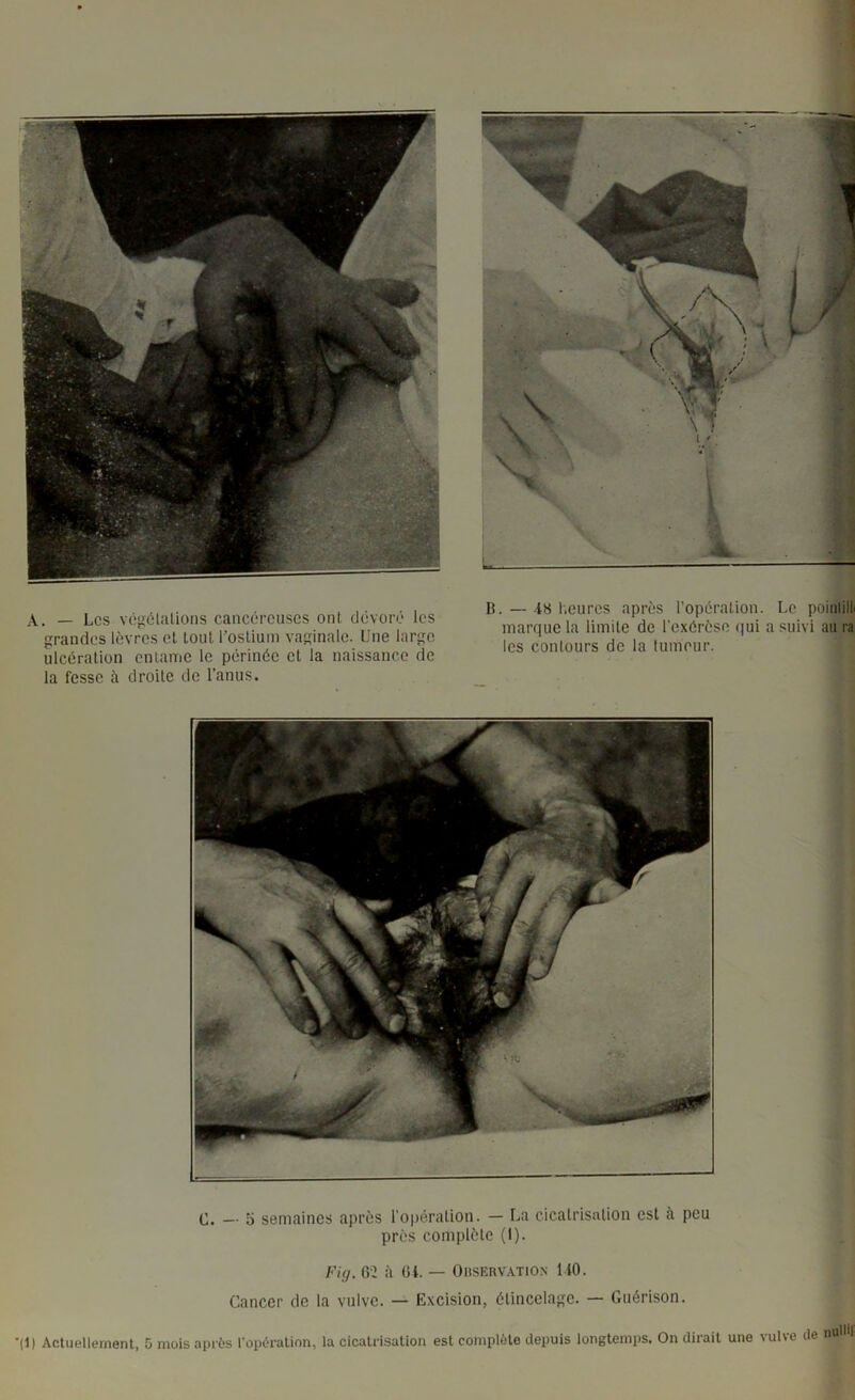 • 1 A. — Les végélalions cancéreuses ont, dévoré les grandes lèvres cl tout rosliuni vaginale. Une large ulcération entame le périnée et la naissance de la fesse à droite de l’anus. B. — l'.eures après l’opération. Le poiiilill marque la limite de l'exérèse (jui a suivi au ra les conlours de la tumeur. C. — 5 semaines après l’opération. — La cicatrisation est à peu près complète (I). Fig. 62 à 61. — OnsERVATiON UO. Cancer de la vulve. — Excision, étincelage. — Guérison. ’(l) Actuellement, 5 mois après l’opération, la cicatrisation est complète depuis longtemps. On dirait une vulve de nuUil