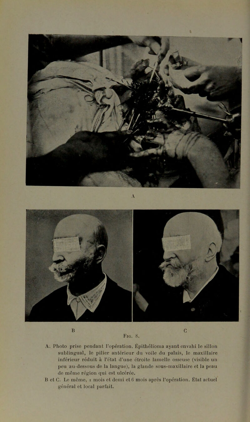 B C Fig. 8. A. Photo prise pendant l’opération. Épithélioma ayant envahi le sillon sublingual, le pilier antérieur du voile du palais, le maxillaire inférieur réduit à l’état d’une étroite lamelle osseuse (visible un peu au-dessous de la langue), la glande sous-maxillaire et la peau de même région qui est ulcérée. B et C. Le même, i mois et demi et G mois après l’opération. État actuel général et local parfait.