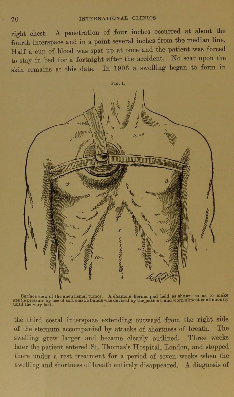 right chest. A penetration of four inches occurred at about the fourth interspace and in a point several inches from the median line. Half a cup of blood was spat up at once and the patient was forced to stay in bed for a fortnight after the accident. Ho scar upon the skin remains at this date. In 1906 a swelling began to form in Fiq. 1. Surface view of the aneurismal tumor. A chamois hernia pad held as shown so as to make gentle pressure by use of soft elastic bands was devised by the.patient, and worn almost continuously until the very last. the third costal interspace extending outward from the right side of the sternum accompanied by attacks of shortness of breath. The swelling grew larger and became clearly outlined. Three weeks later the patient entered St. Thomas’s Hospital, London, and stopped there under a rest treatment for a period of seven weeks when the swelling and shortness of breath entirely disappeared. A diagnosis of