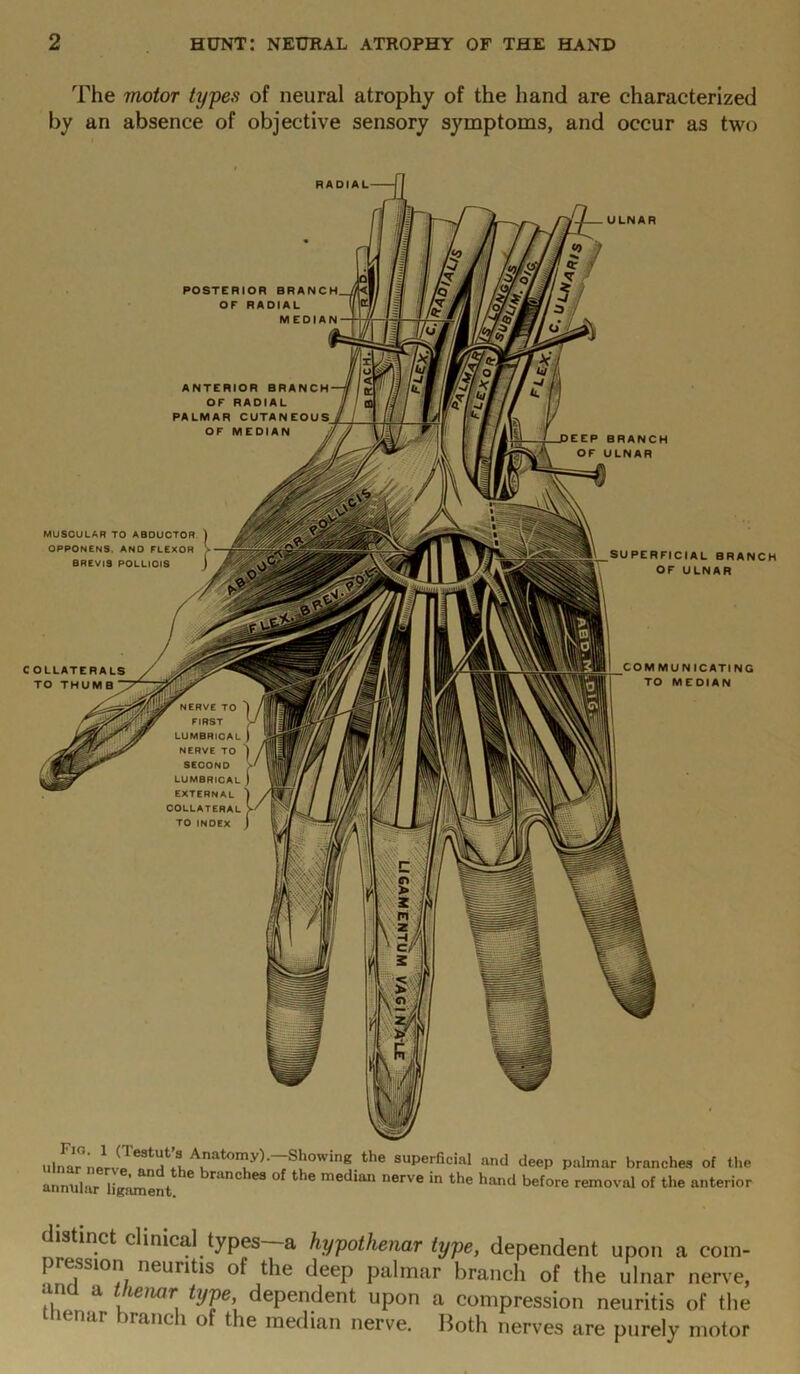 The motor types of neural atrophy of the hand are characterized by an absence of objective sensory symptoms, and occur as two ULNAR POSTERIOR BRANC OF RADIAL MEDIA ANTERIOR BRANCH OF RADIAL PALMAR CUTANEOUS. OF MEDIAN MUSCULAR TO ABDUCTOR OPPONENS. AND FLEXOR BREVIS POLLICIS SUPERFICIAL BRANCH OF ULNAR COLLATERALS / TO THUMB  COMMUNICATING TO MEDIAN ulnar nervAnator”y^ Showing the superficial and deep palmar branches of the annular ligament 6 median nerVe in the hand before removal of the anterior < istinct clinical types—a hypothenar type, dependent upon a com- pression neuritis of the deep palmar branch of the ulnar nerve, ana a thenar hjpe, dependent upon a compression neuritis of the ienar branch of the median nerve. Both nerves are purely motor