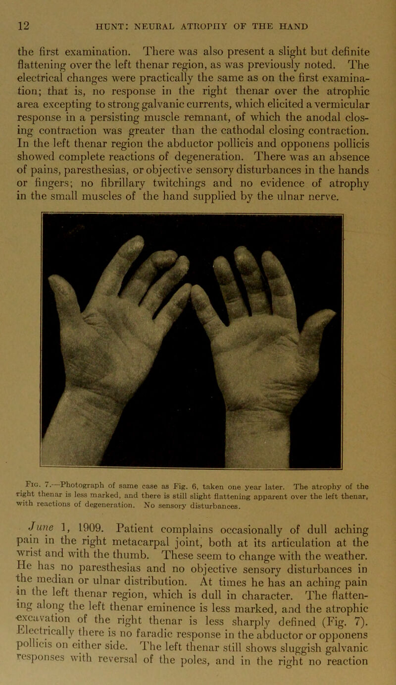 the first examination. There was also present a slight but definite flattening over the left thenar region, as was previously noted. The electrical changes were practically the same as on the first examina- tion; that is, no response in the right thenar over the atrophic area excepting to strong galvanic currents, which elicited a vermicular response in a persisting muscle remnant, of which the anodal clos- ing contraction was greater than the cathodal closing contraction. In the left thenar region the abductor pollicis and opponens pollicis showed complete reactions of degeneration. There was an absence of pains, paresthesias, or objective sensory disturbances in the hands or fingers; no fibrillary twitchings and no evidence of atrophy in the small muscles of the hand supplied by the ulnar nerve. Fig. i.- Photograph of same case as P'ig. 6, taken one year later. The atrophy of the right thenar is less marked, and there is still slight flattening apparent over the left thenar, with reactions of degeneration. No sensory disturbances. J une 1, 1909. Patient complains occasionally of dull aching pain in the right metacarpal joint, both at its articulation at the wrist and with the thumb. These seem to change with the weather, lie has no paresthesias and no objective sensory disturbances in the median or ulnar distribution. At times he has an aching pain m the left thenar region, which is dull in character. The flatten- ing along the left thenar eminence is less marked, and the atrophic ■excavation of the right thenar is less sharply defined (Fig. 7). * metrically there is no faradic response in the abductor or opponens po icis on either side. The left thenar still shows sluggish galvanic r< spouses with reversal of the poles, and in the right no reaction