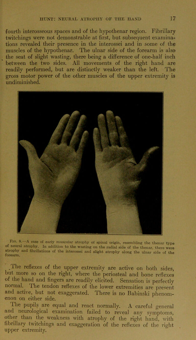 fourth interosseous spaces and of the hypothenar region. Fibrillary twitchings were not demonstrable at first, but subsequent examina- tions revealed their presence in the interossei and in some of the muscles of the hypothenar. The ulnar side of the forearm is also the seat of slight wasting, there being a difference of one-half inch between the two sides. All movements of the right hand are readily performed, but are distinctly weaker than the left. The gross motor power of the other muscles of the upper extremity is undiminished. Fig. 8.—A case of early muscular atrophy of spinal origin, resembling the thenar type of neural atrophy. In addition to the wasting on the radial side of the thenar, there were atrophy and fibrillations of the interossei and slight atrophy along the ulnar side of the forearm. .The reflexes of the upper extremity are active on both sides, but more so on the right, where the periosteal and bone reflexes of the hand and fingers are readily elicited. Sensation is perfectly normal. The tendon reflexes of the lower extremities are present and acti\ e, but not exaggerated. There is no Babinski phenom- enon on either side. I he pupils are equal and react normally. A careful general and neurological examination failed to reveal any symptoms, other than the weakness with atrophy of the right hand, with fibrillary twitchings and exaggeration of the reflexes of the right upper extremity.