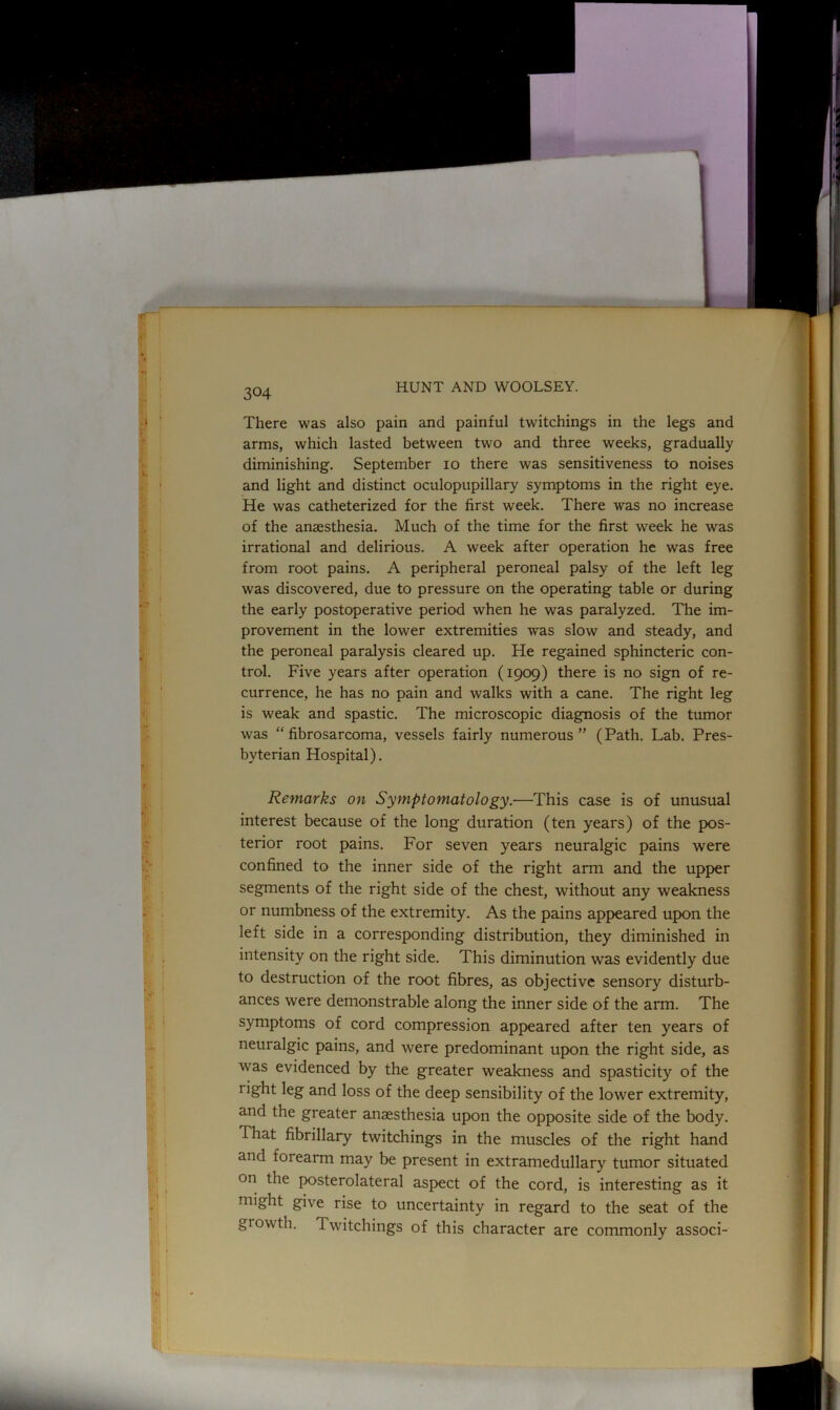 There was also pain and painful twitchings in the legs and arms, which lasted between two and three weeks, gradually diminishing. September io there was sensitiveness to noises and light and distinct oculopupillary symptoms in the right eye. He was catheterized for the first week. There was no increase of the anaesthesia. Much of the time for the first week he was irrational and delirious. A week after operation he was free from root pains. A peripheral peroneal palsy of the left leg was discovered, due to pressure on the operating table or during the early postoperative period when he was paralyzed. The im- provement in the lower extremities was slow and steady, and the peroneal paralysis cleared up. He regained sphincteric con- trol. Five years after operation (1909) there is no sign of re- currence, he has no pain and walks with a cane. The right leg is weak and spastic. The microscopic diagnosis of the tumor was “fibrosarcoma, vessels fairly numerous” (Path. Lab. Pres- byterian Hospital). Remarks on Symptomatology.—This case is of unusual interest because of the long duration (ten years) of the pos- terior root pains. For seven years neuralgic pains were confined to the inner side of the right arm and the upper segments of the right side of the chest, without any weakness or numbness of the extremity. As the pains appeared upon the left side in a corresponding distribution, they diminished in intensity on the right side. This diminution was evidently due to destruction of the root fibres, as objective sensory disturb- ances were demonstrable along the inner side of the arm. The symptoms of cord compression appeared after ten years of neuralgic pains, and were predominant upon the right side, as was evidenced by the greater weakness and spasticity of the 1 ight leg and loss of the deep sensibility of the lower extremity, and the greater anaesthesia upon the opposite side of the body. I hat fibrillary twitchings in the muscles of the right hand and forearm may be present in extramedullary tumor situated on the posterolateral aspect of the cord, is interesting as it might give rise to uncertainty in regard to the seat of the growth. Twitchings of this character are commonly associ-