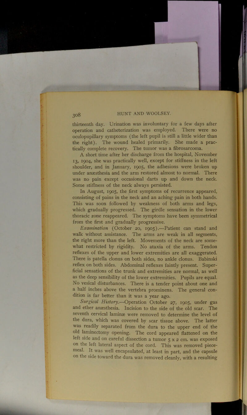 thirteenth day. Urination was involuntary for a few days after operation and catheterization was employed. There were no oculopupillary symptoms (the left pupil is still a little wider than the right). The wound healed primarily. She made a prac- tically complete recovery. The tumor was a fibrosarcoma. A short time after her discharge from the hospital, November 13, 1904, she was practically well, except for stiffness in the left shoulder, and in January, 1905, the adhesions were broken up under anaesthesia and the arm restored almost to normal. There was no pain except occasional darts up and down the neck. Some stiffness of the neck always persisted. In August, 1905, the first symptoms of recurrence appeared, consisting of pains in the neck and an aching pain in both hands. This was soon followed by weakness of both arms and legs, which gradually progressed. The girdle sensation in the lower thoracic zone reappeared. The symptoms have been symmetrical from the first and gradually progressive. Examination (October 20, 1905).—Patient can stand and walk without assistance. The arms are weak in all segments, the right more than the left. Movements of the neck are some- what restricted by rigidity. No ataxia of the arms. Tendon reflexes of the upper and lower extremities are all exaggerated. There is patella clonus on both sides, no ankle clonus. Babinski reflex on both sides. Abdominal reflexes faintly present. Super- ficial sensations of the trunk and extremities are normal, as well as the deep sensibility of the lower extremities. Pupils are equal. No vesical disturbances. There is a tender point about one and a half inches above the vertebra prominens. The general con- dition is far better than it was a year ago. Surgical History.—Operation October 27, 1905, under gas and ether anaesthesia. Incision to the side of the old scar. The seventh cervical laminae were removed to determine the level of the dura, which was covered by scar tissue above. The latter was readily separated from the dura to the upper end of the old laminectomy opening. The cord appeared flattened on the left side and on careful dissection a tumor 5 x 2 cm. was exposed on the left lateral aspect of the cord. This was removed piece- meal. It was well encapsulated, at least in part, and the capsule on the side toward the dura was removed cleanly, with a resulting