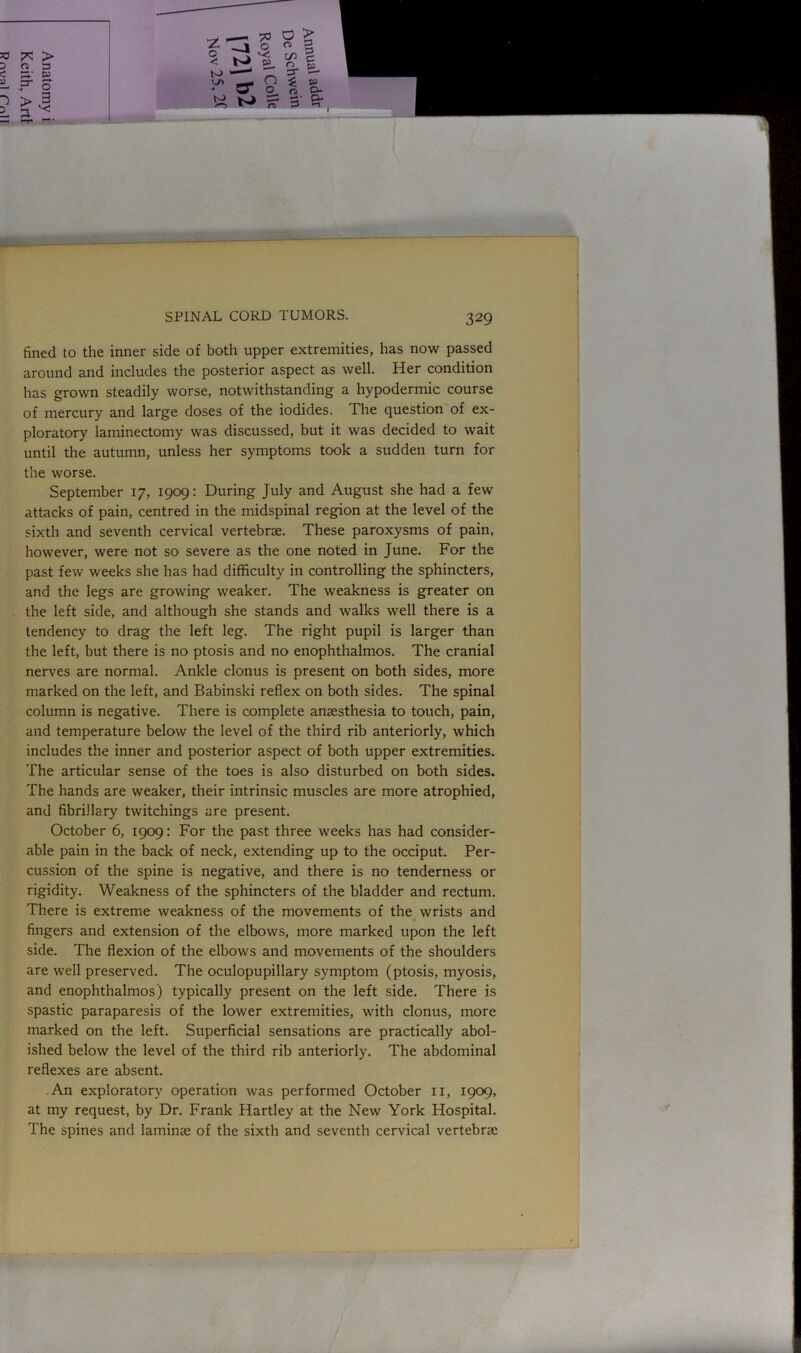 fined to the inner side of both upper extremities, has now passed around and includes the posterior aspect as well. Her condition has grown steadily worse, notwithstanding a hypodermic course of mercury and large doses of the iodides. The question of ex- ploratory laminectomy was discussed, but it was decided to wait until the autumn, unless her symptoms took a sudden turn for the worse. September 17, 1909: During July and August she had a few attacks of pain, centred in the midspinal region at the level of the sixth and seventh cervical vertebrae. These paroxysms of pain, however, were not so severe as the one noted in June. For the past few weeks she has had difficulty in controlling the sphincters, and the legs are growing weaker. The weakness is greater on the left side, and although she stands and walks well there is a tendency to drag the left leg. The right pupil is larger than the left, but there is no ptosis and no enophthalmos. The cranial nerves are normal. Ankle clonus is present on both sides, more marked on the left, and Babinski reflex on both sides. The spinal column is negative. There is complete anaesthesia to touch, pain, and temperature below the level of the third rib anteriorly, which includes the inner and posterior aspect of both upper extremities. The articular sense of the toes is also disturbed on both sides. The hands are weaker, their intrinsic muscles are more atrophied, and fibrillary twitchings are present. October 6, 1909: For the past three weeks has had consider- able pain in the back of neck, extending up to the occiput. Per- cussion of the spine is negative, and there is no tenderness or rigidity. Weakness of the sphincters of the bladder and rectum. There is extreme weakness of the movements of the wrists and fingers and extension of the elbows, more marked upon the left side. The flexion of the elbows and movements of the shoulders are well preserved. The oculopupillary symptom (ptosis, myosis, and enophthalmos) typically present on the left side. There is spastic paraparesis of the lower extremities, with clonus, more marked on the left. Superficial sensations are practically abol- ished below the level of the third rib anteriorly. The abdominal reflexes are absent. An exploratory operation was performed October 11, 1909, at my request, by Dr. Frank Hartley at the New York Hospital. The spines and laminae of the sixth and seventh cervical vertebrae