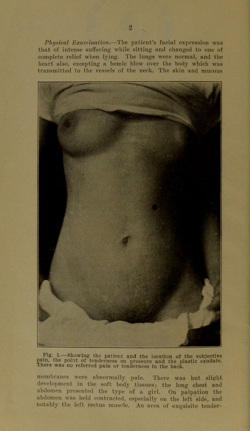 Physical Examination.—The patient’s facial expression was that of intense suffering while sitting and changed to one of complete relief when lying. The lungs were normal, and the heart also, excej)ting a hemic blow over the body which was transmitted to the vessels of the neck. The skin and mucous 1-—Showing the patient and the location of the subjective pain, the point of tenderness on pressure and the plastic exudate. There was no referred pain or tenderness in the back. membranes \vere abnormally pale. There w'as but slierht development in the soft body tissues; the long chest and abdomen ])resented the type of a girl. On palpation the abdomen was held contracted, especially on the left side, and iiotably the left rectus muscle. An area of e.xquisite tender-