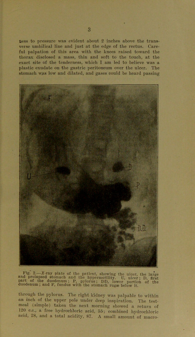 Uess to pressure was evident about 2 inches above the trans- verse umbilical line and just at the edge of the rectus. Care- ful palpation of this area with the knees raised toward the thorax disclosed a mass, thin and soft to the touch, at the exact site of the tenderness, which I am led to believe was a plastic exudate on the gastric peritoneum over the ulcer. The stomach was low and dilated, and gases could be heard passing Pie- 2-—X-ray plate of the patient, showing the ulcer, the large and prolapsed stomach and the hypermotility. U, ulcer; D, first part of the duodenum ; P, pylorus; DD, lower portion of the duodenum ; and P, fundus with the stomach rugae below It. through the pylorus. The right kidney was palpable to within an inch of the upper pole under deep inspiration. The test- meal (simple) taken the ne.xt morning showed a return of 120 C.C., a free hydrochloric acid, 65; combined hydrochloric acid, 28, and a total acidity, 87. A small amount of macro-