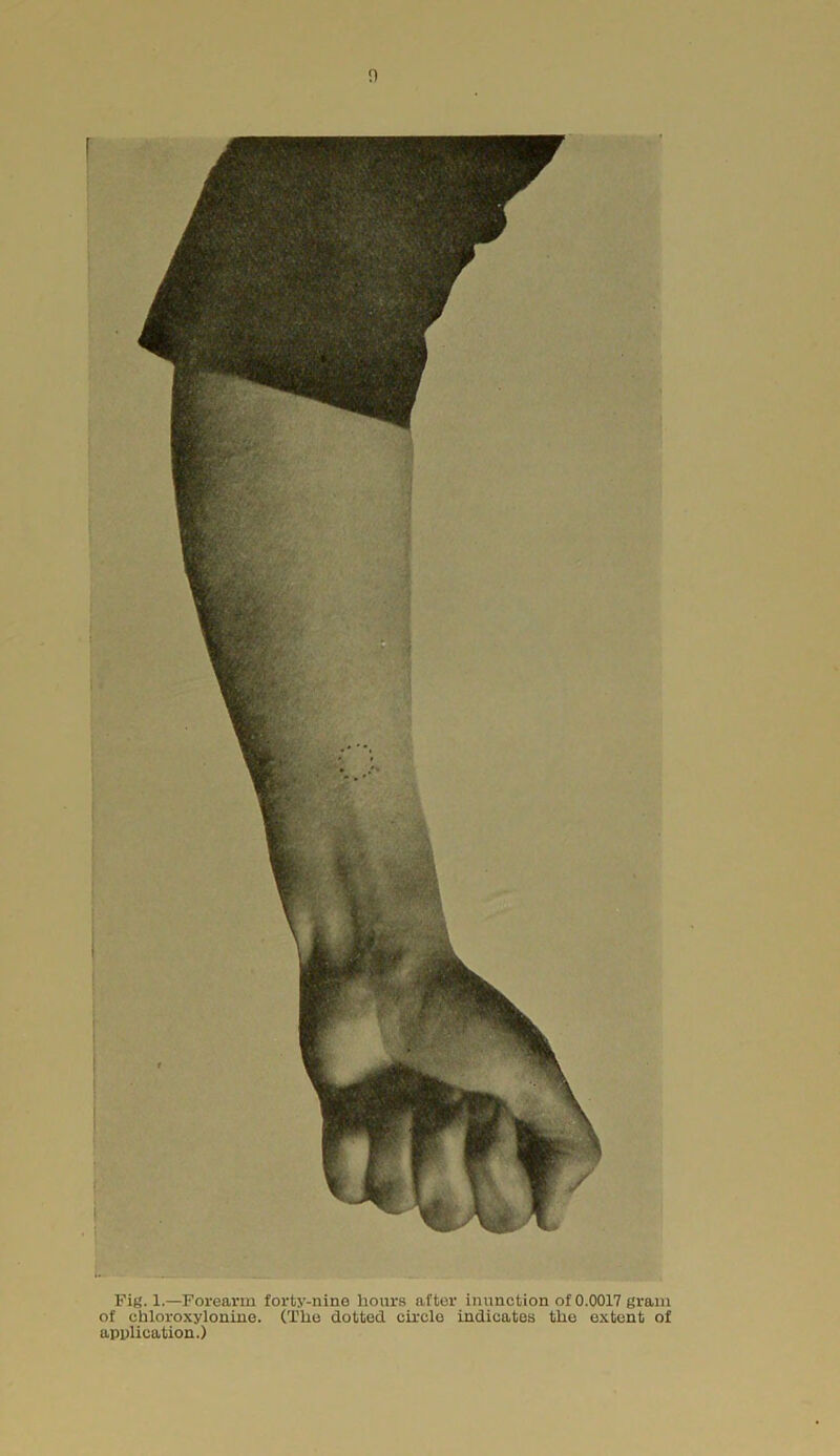 Fig. 1.—Forearm forty-nine hours after inunction of 0.0017 gram of chloroxylonine. (The dotted circle indicates the extent of application.)