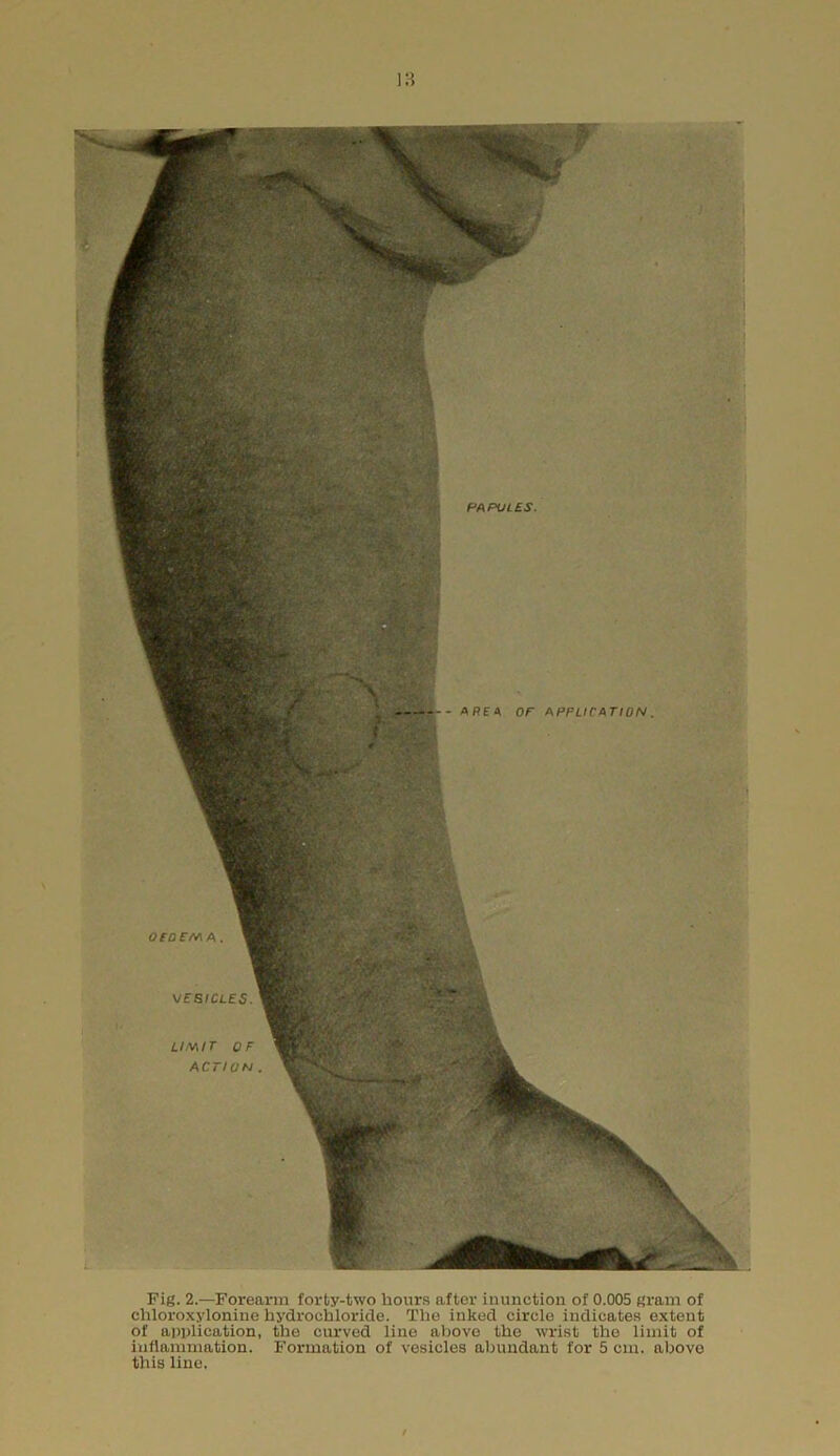 PAPULES. AREA OF APPLICATION LIMIT OF ACTION Fig. 2.—Forearm forty-two hours after inunction of 0.005 gram of chloroxylonine hydrochloride. The inked circle indicates extent of application, the curved line above the wrist the limit of inflammation. Formation of vesicles abundant for 5 cm. above this line,