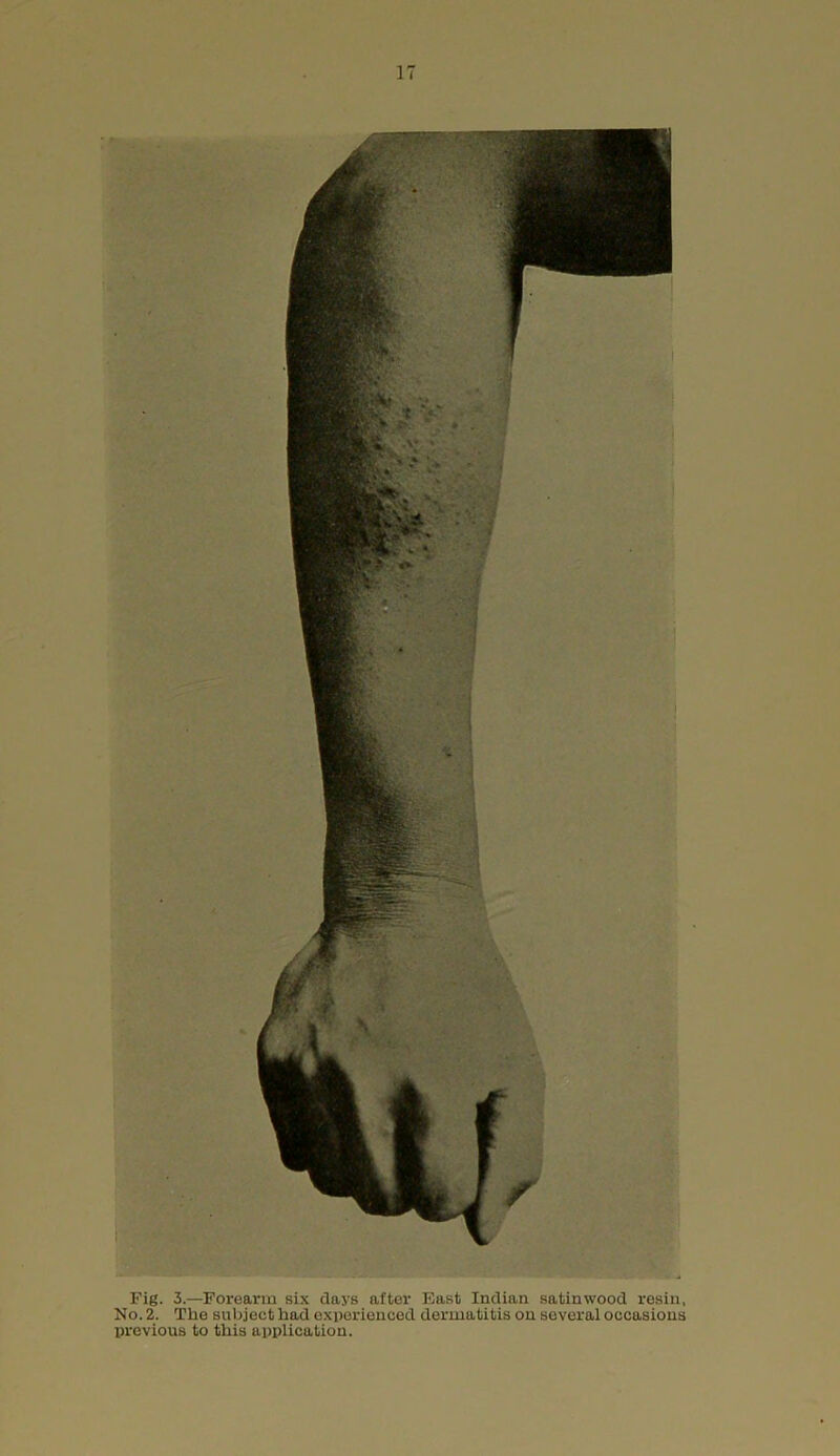 Fig. 3.—Forearm six days after East Indian satinwood resin. No. 2. The subject had experienced dermatitis on several occasions previous to this application.