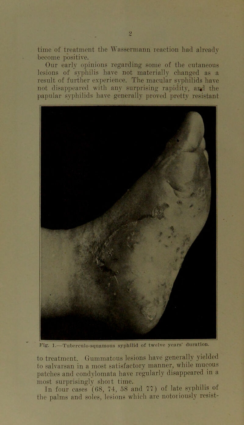 time of treatment the Wassermann reaction had already become positive. Our early opinions regarding some of the cutaneous lesions of syphilis have not materially changed as a result of further experience. The macular syphilids have not disappeared with any surprising rapidity, ai*l the papular syphilids have generally proved pretty resistant to treatment. Gummatous lesions have generally yielded to salvarsan in a most satisfactory manner, while mucous patches and condylomata have regularly disappeared in a most surprisingly shoit time. In four cases (68, 74, 58 and 77) of late syphilis of the palms and soles, lesions which are notorious!}' resist-