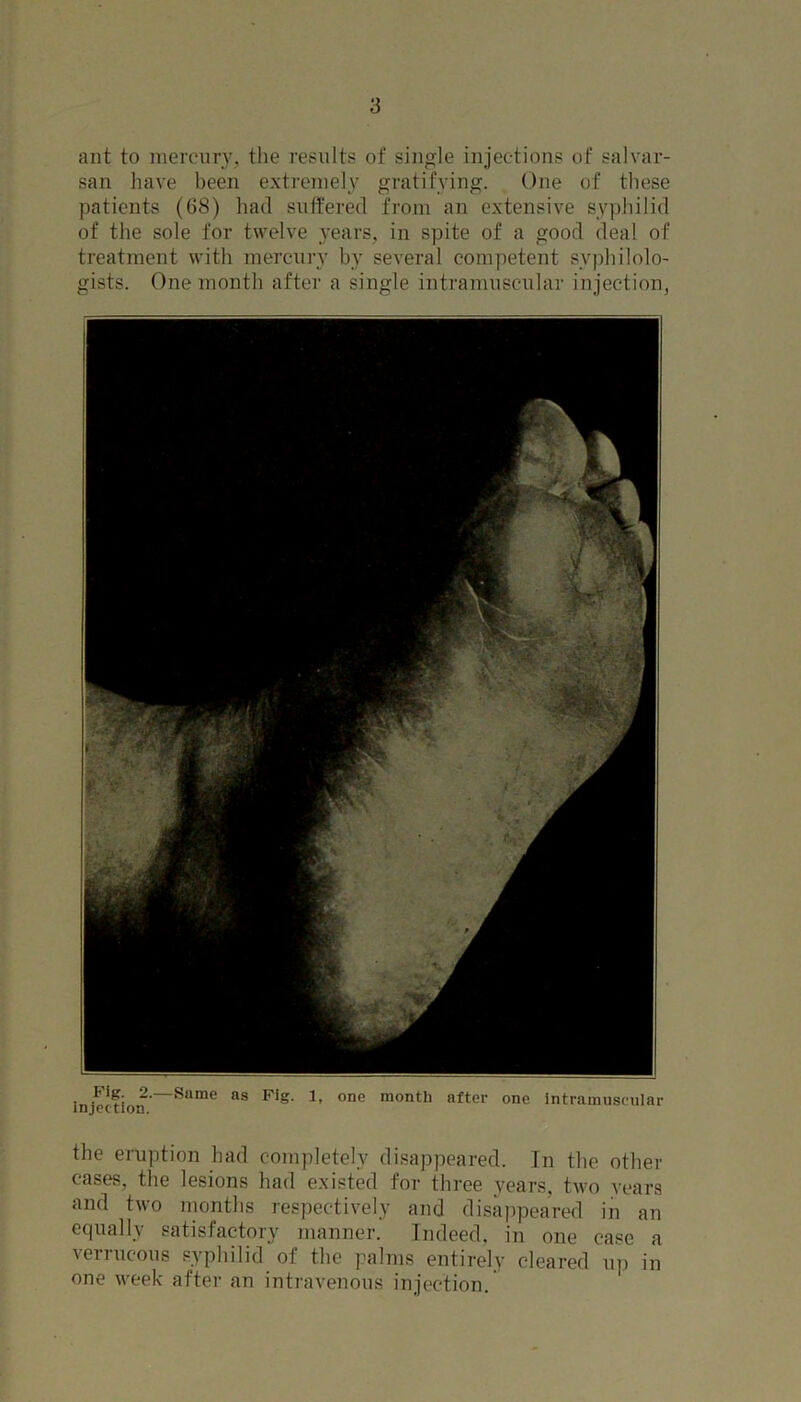 ant to mercury, the results of single injections of salvar- san have been extremely gratifying. One of these patients (68) had suffered from an extensive syphilid of the sole for twelve years, in spite of a good deal of treatment with mercury by several competent svphilolo- gists. One month after a single intramuscular injection, Fig. 2.—Same as Pig. 1, one month after one intramuscular injection. the eruption had completely disappeared. In the other cases, the lesions had existed for three years, two years and two months respectively and disappeared in an equally satisfactory manner. Indeed, in one case a verrucous syphilid of the palms entirely cleared up in one week after an intravenous injection.